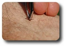 Using forceps to remove a tick. 