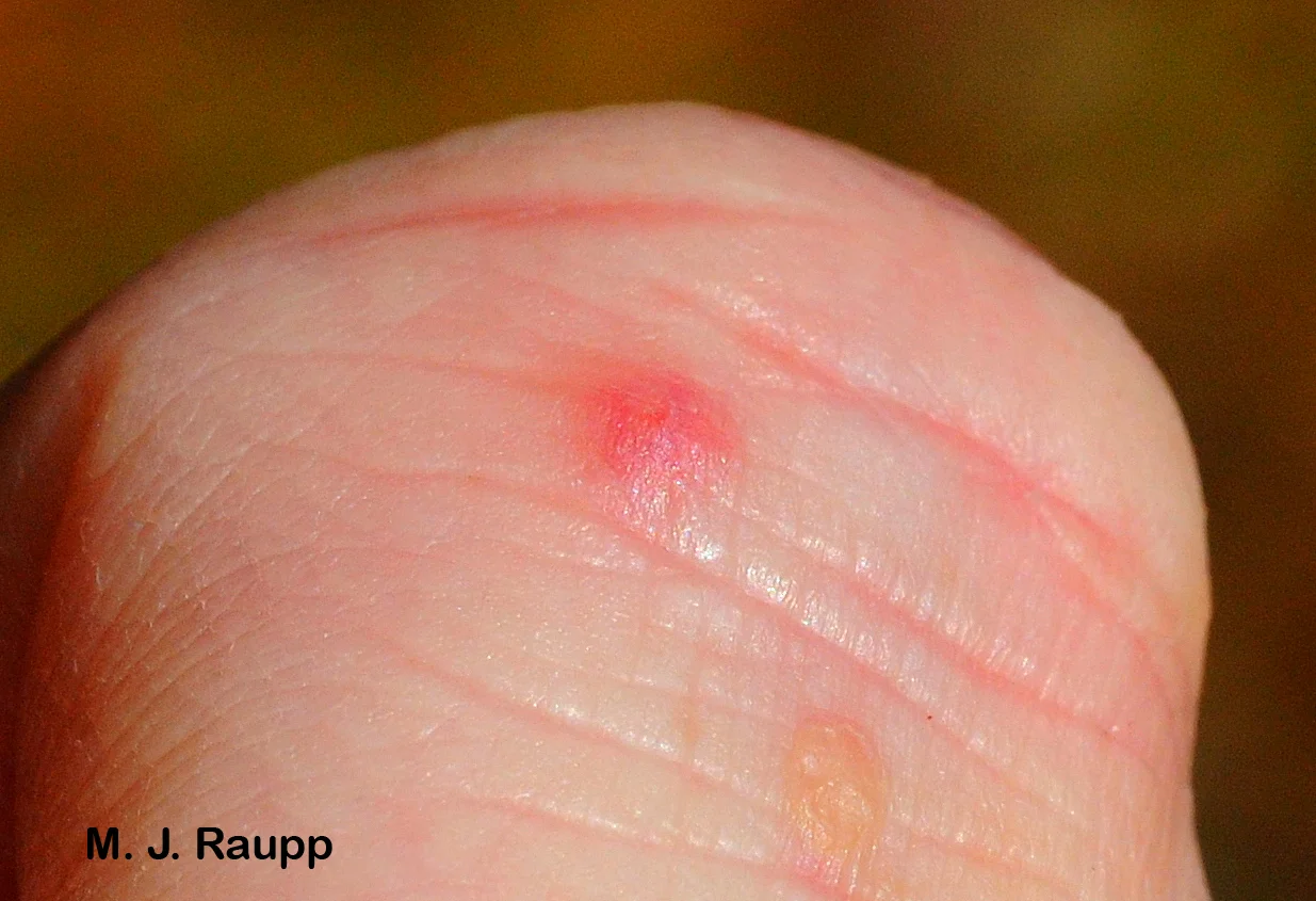 One day after being stung, a small itchy welt appeared on my finger.