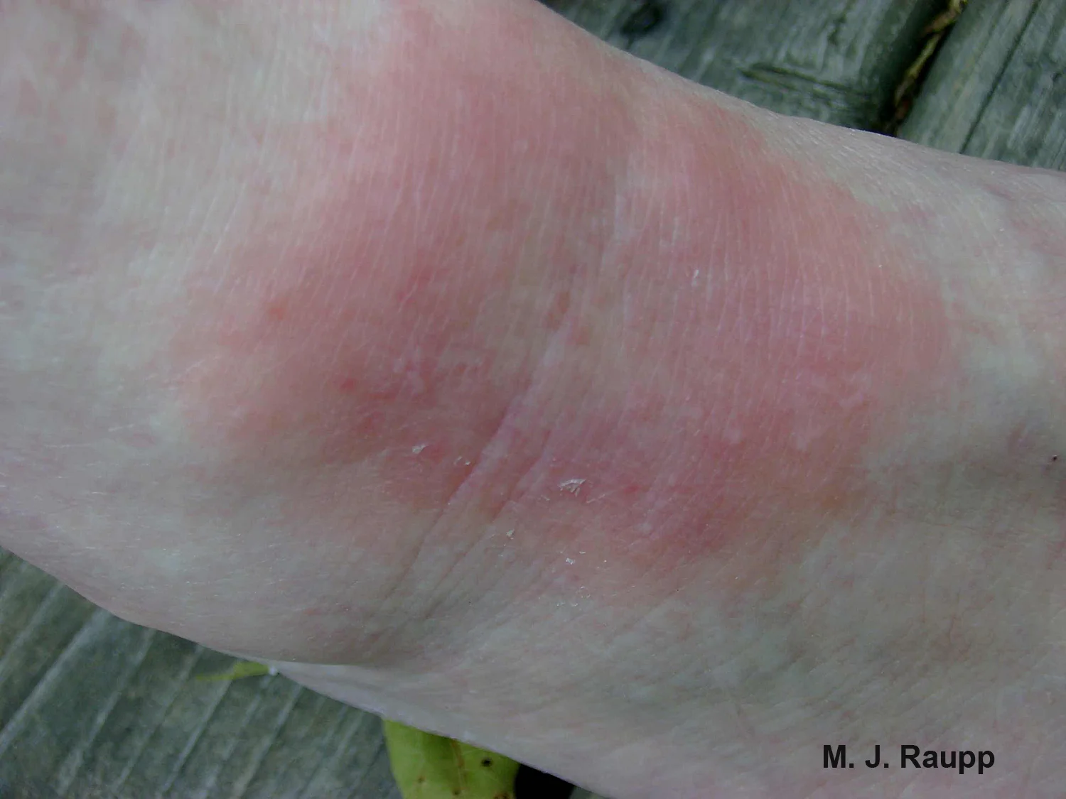 A bull’s eye rash is one of the characteristic symptoms of Lyme disease.