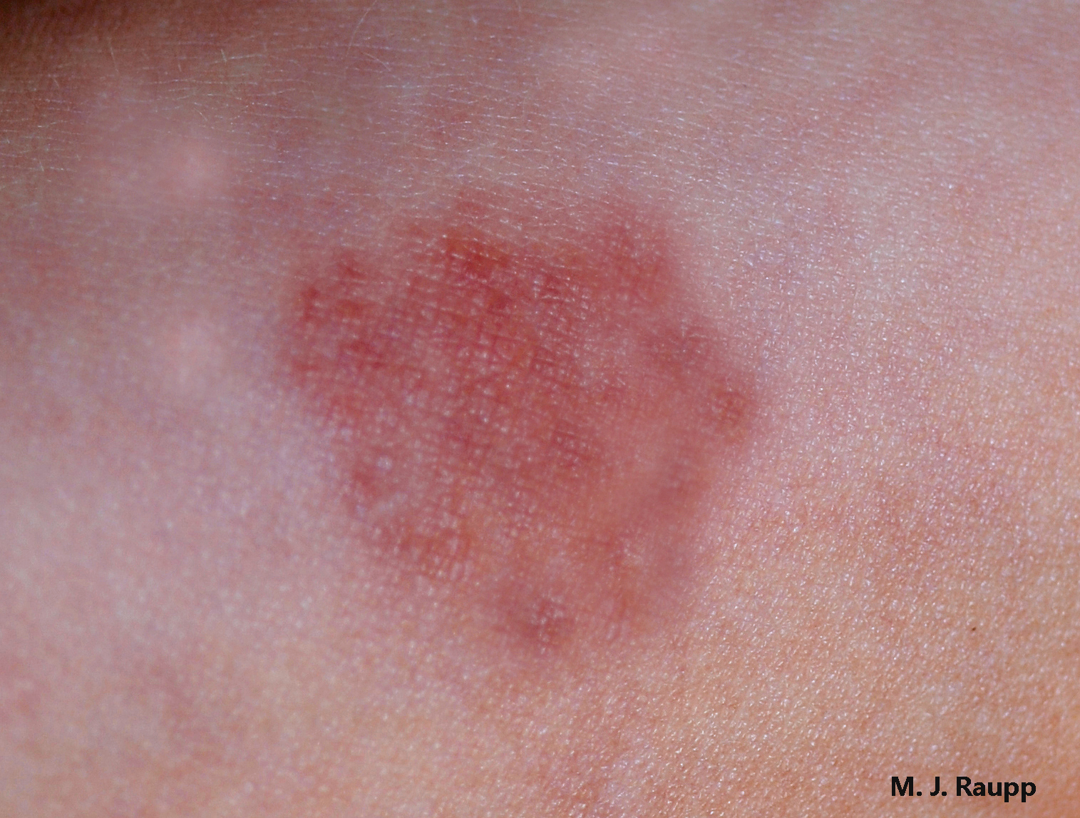 Skin rash where bed bugs fed on sensitive individual.
