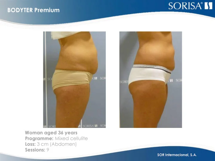 Før-etter-bilder-BODYTER-Pr.jpg