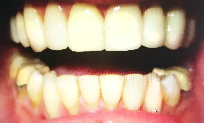 Uppers: American veneer falsies. Lowers: British originals after four months of braces