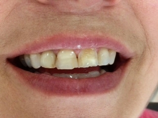 Before Treatment