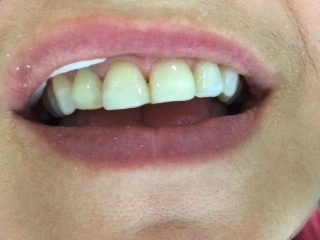 After Treatment