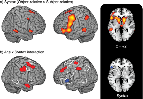 Top: Brain regions that show an increased response for syntactically-complex spoken sentences in both young and older adults. Bottom: Regions in which this syntax-related activity differs as a function of age; note that older adults show increased activity in numerous regions of frontal and prefrontal cortex outside the core syntax network. (From Peelle et al., 2010, Cerebral Cortex )