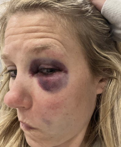 Anchor Takes a Shot to the Eye 