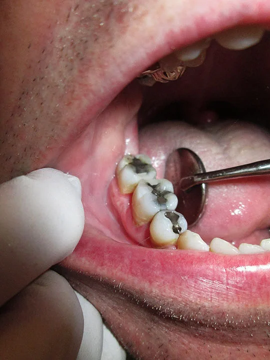 Fixing Two Holes In My Teeth At All Smiles Dental Care — Meanwhile