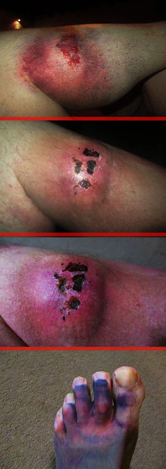 1b. abscessfoot_april10-18.jpg