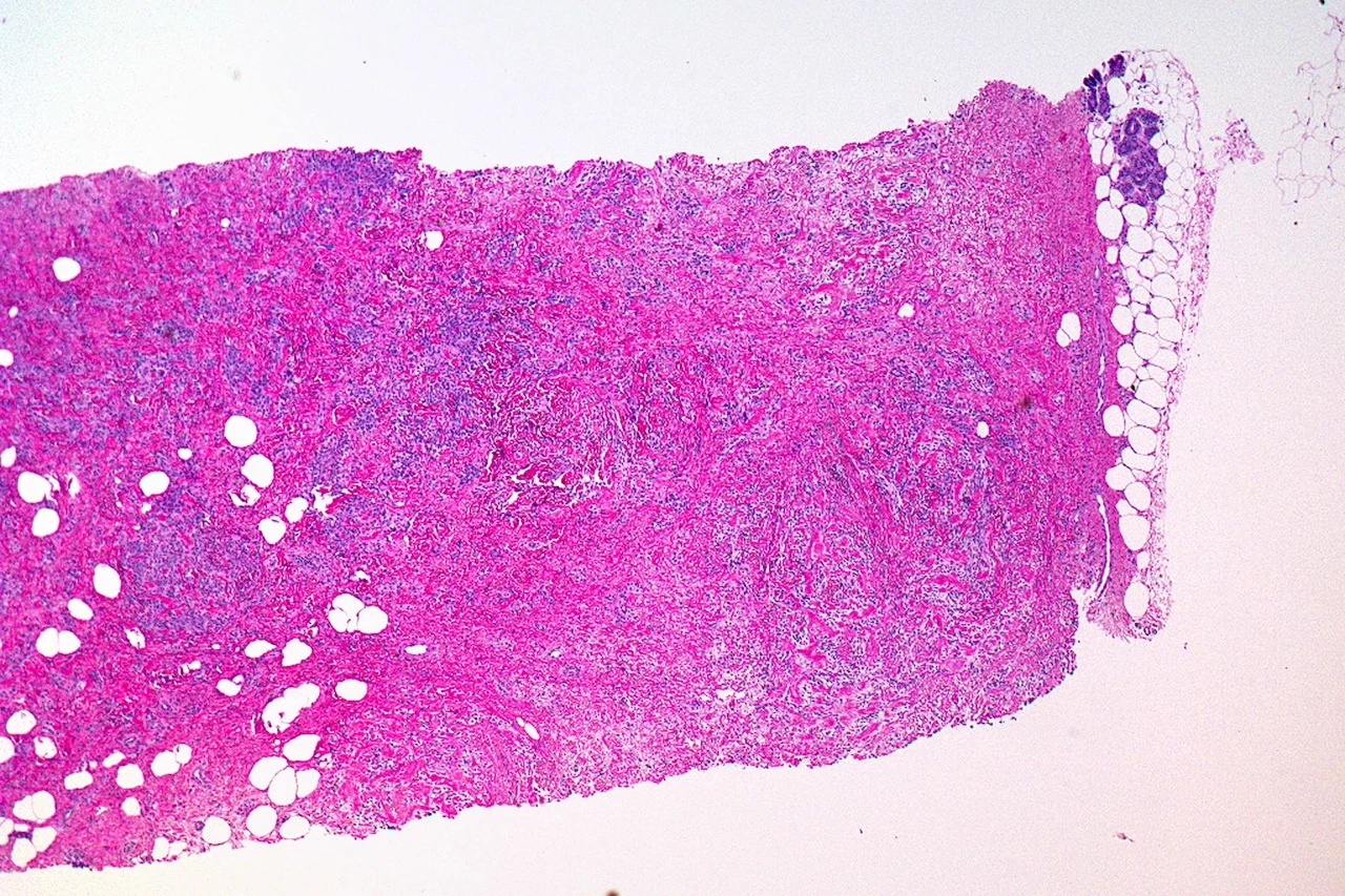 Image 1: Low power magnification of a sharply demarcated cellular proliferation.