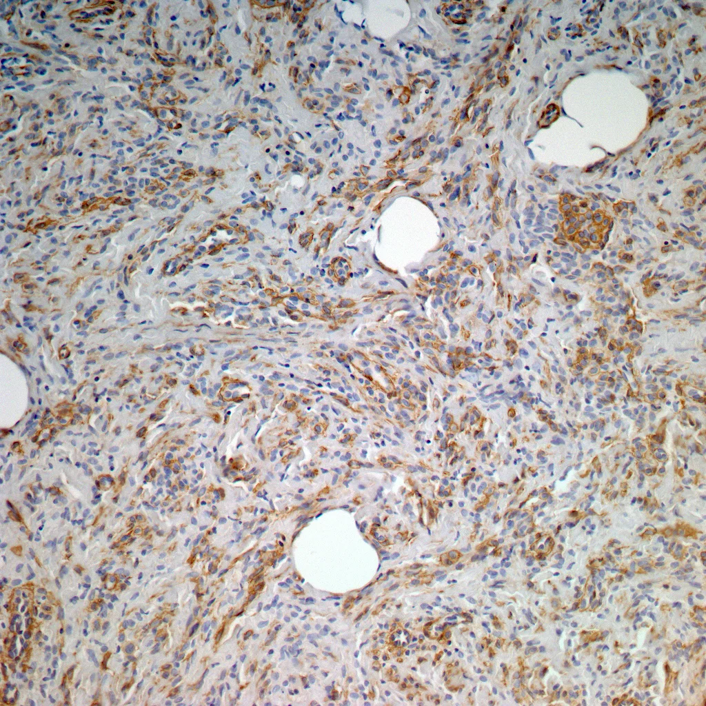 Image 3: Smooth muscle actin highlights the cellular proliferation.