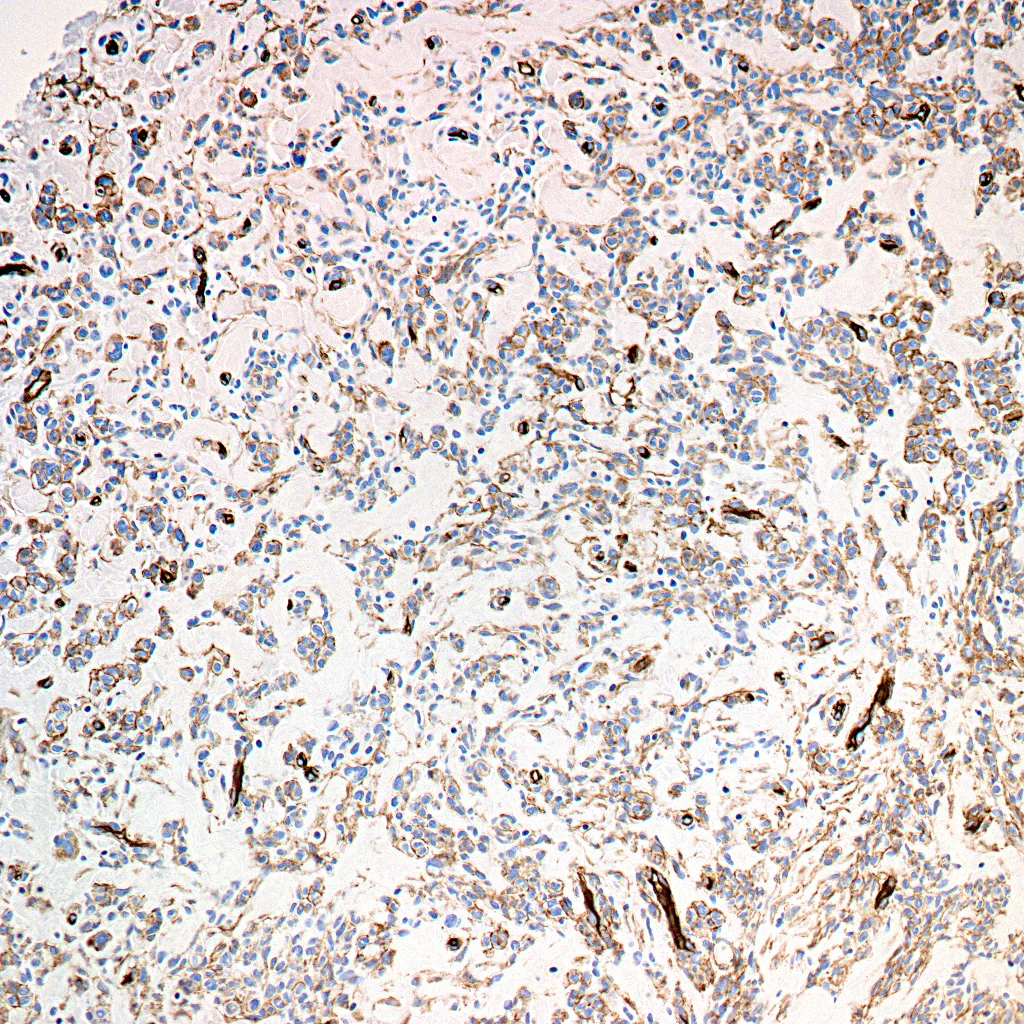 Image 4: The cellular proliferation also expresses CD34.