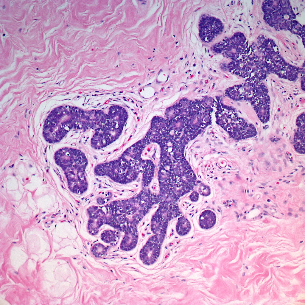 Small lumens with eosinophilic material are formed by the cellular proliferation.