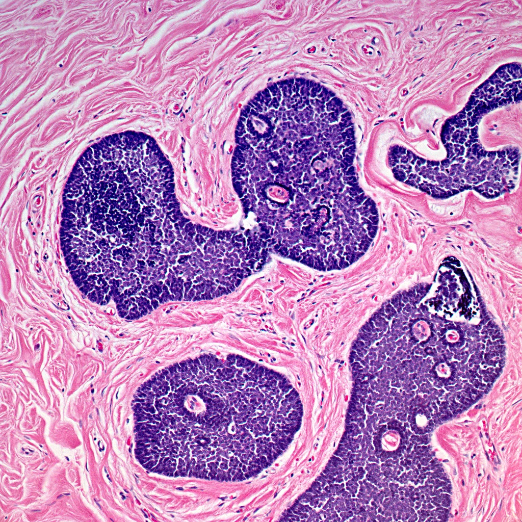 A dual cell population is present with basal-type cells especially prominent at the periphery of the tumor nests. True and false lumens can also be seen.