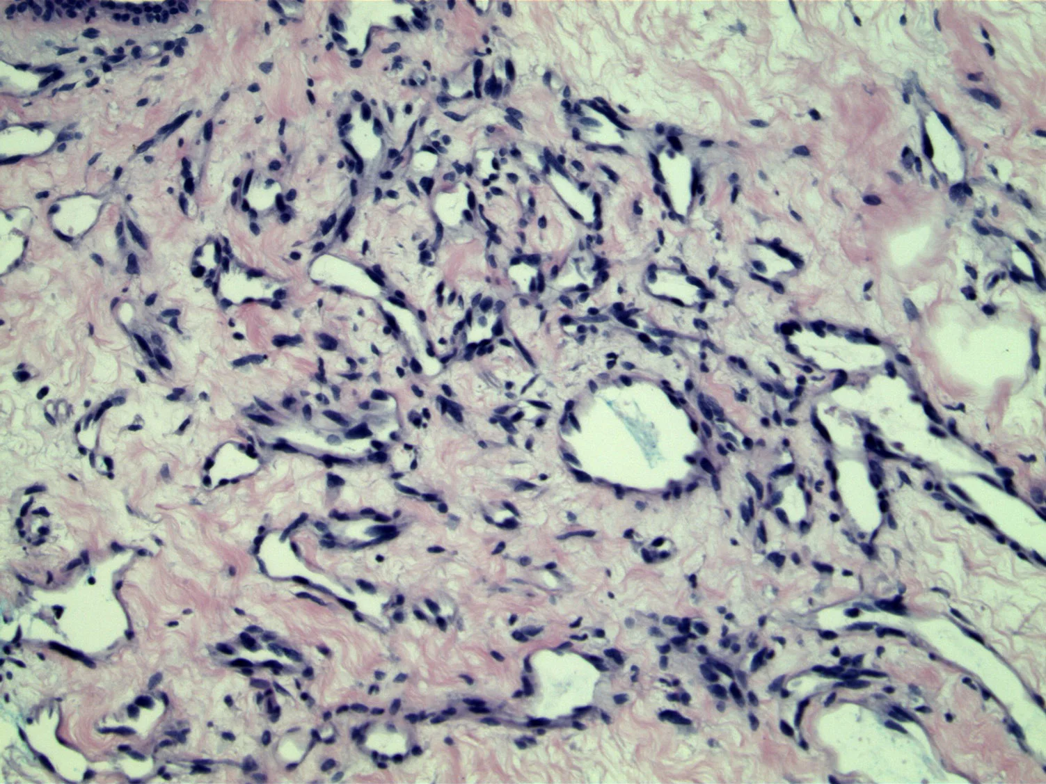 Image 3: Nuclear enlargement and moderate pleomorphism is present in this more solid area of vascular proliferation.