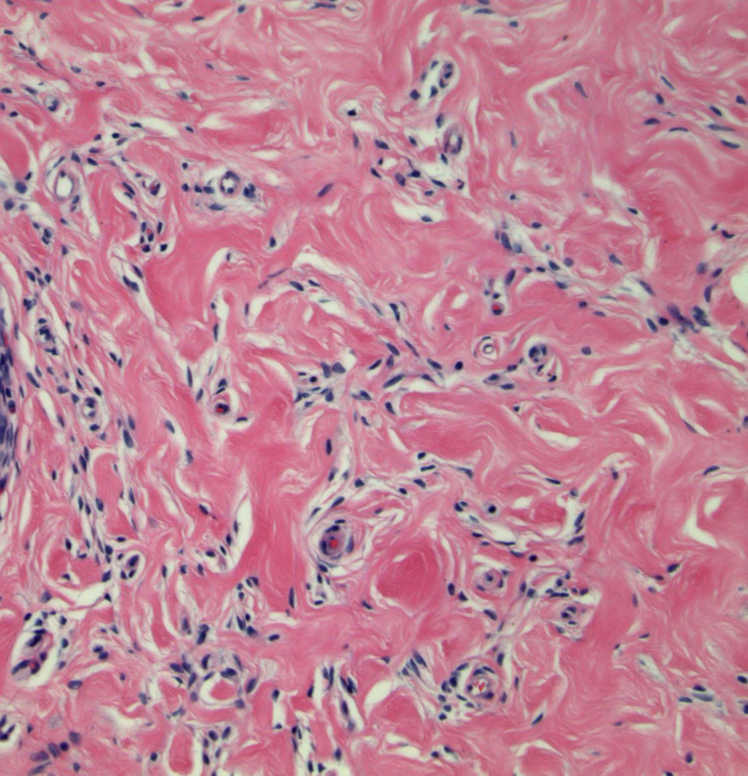 Image 4: Pseudoangiomatous stromal hyperplasia. Dense collagenous stroma contains angulated, interconnecting slit-like spaces that are empty and lined by flattened myofibroblasts.