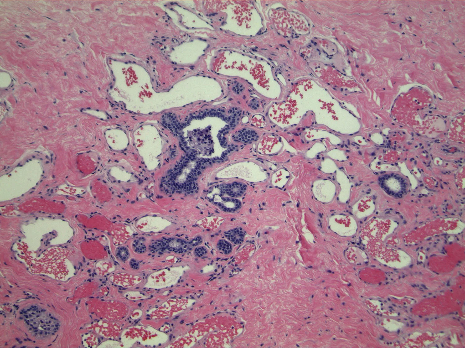 Image 5: Capillary hemangioma. Incidental finding in a patient undergoing excision for atypical ductal hyperplasia (not shown). Lobular configuration of rounded spaces, lined by bland endothelial cells containing red blood cells. 