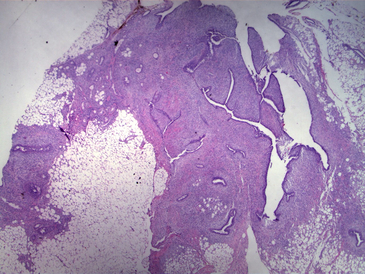 low power magnification shows a fibroepthelial Lesion characterized by cellular stroma and distorted epithelial arrangements. The lesion appears to have an irregular interface with adjacent adipose tissue.