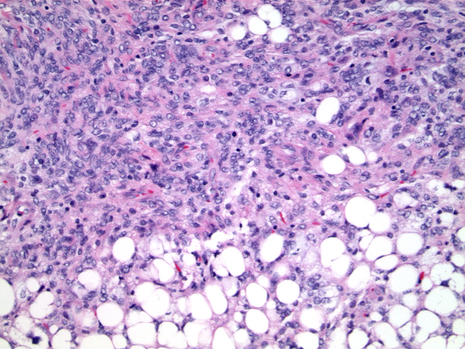 Higher magnification shows hypercellular stroma with mild stromal atypia and mitotic activity.