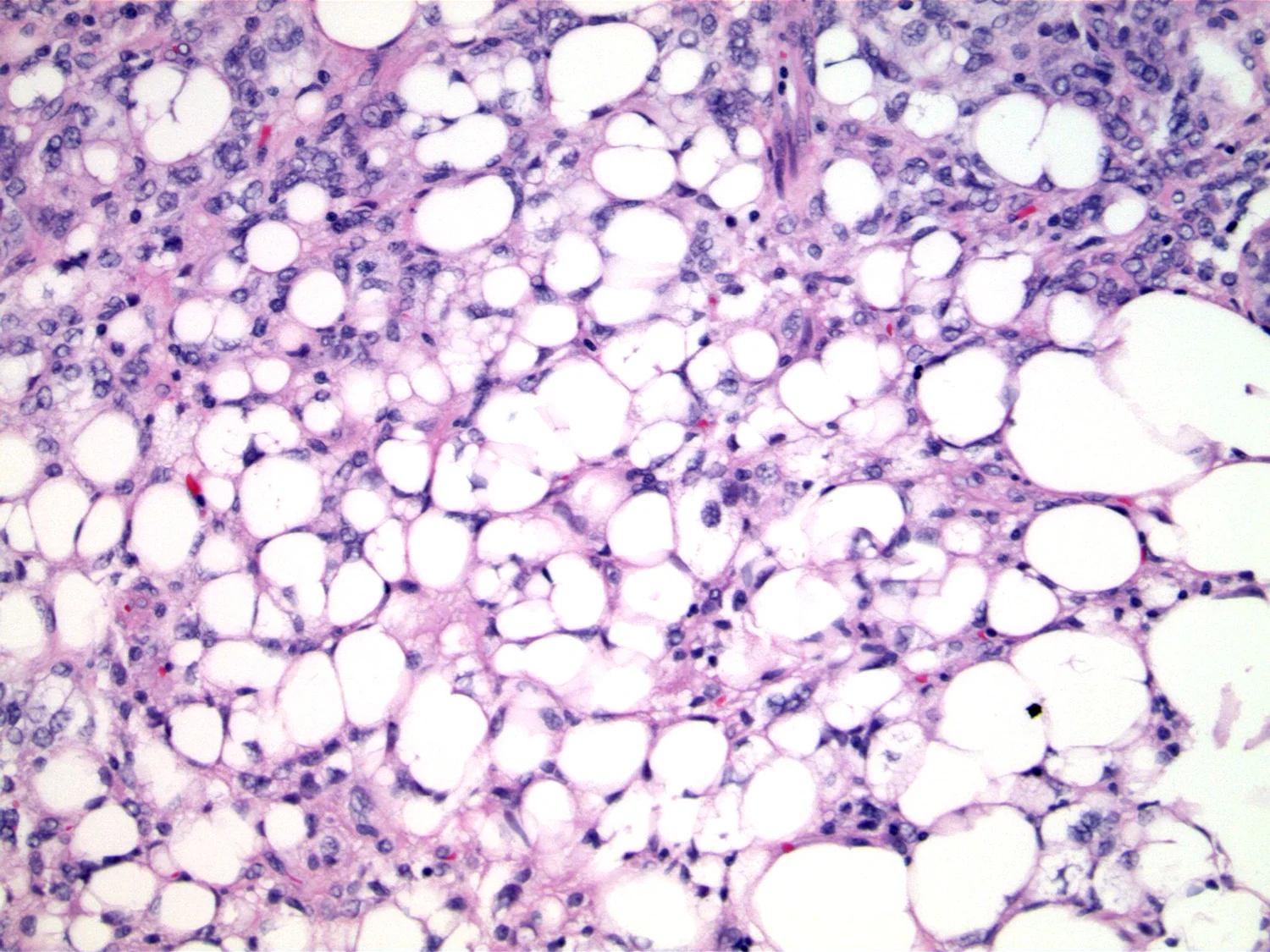 High power shows variably sized fat cells, including numerous lipoblasts. 