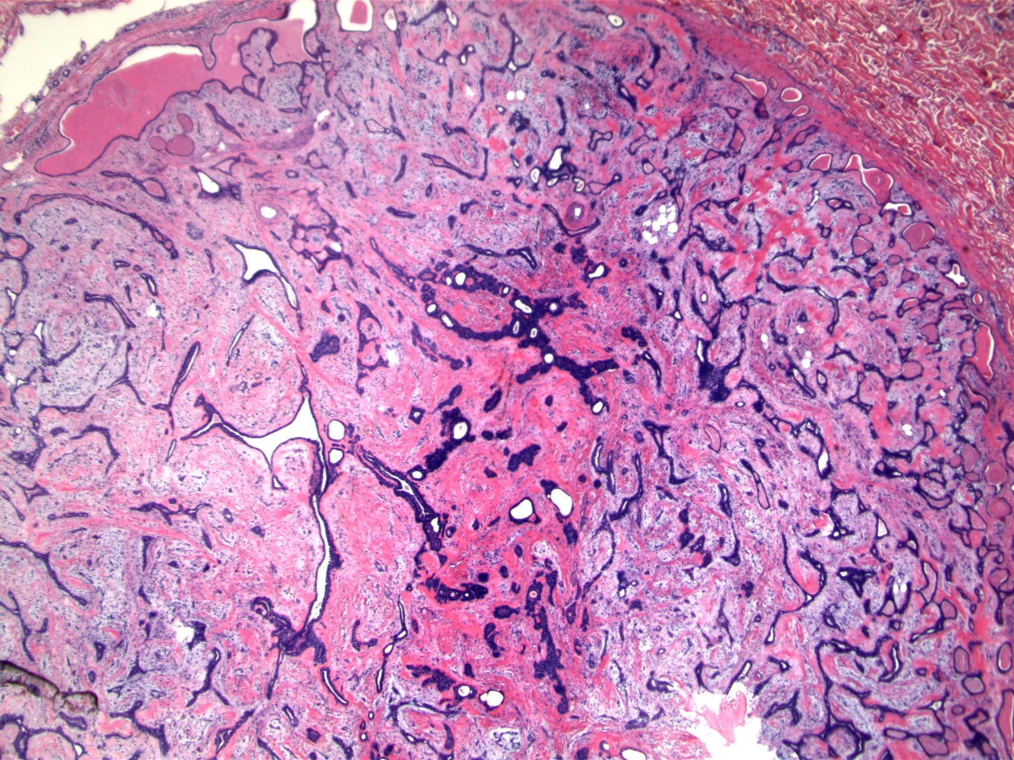 Image 1: The lesion is circumscribed, and consists of epithelial structures evenly distributed in a myxoid stroma. Some of the epithelial structures form clefts.