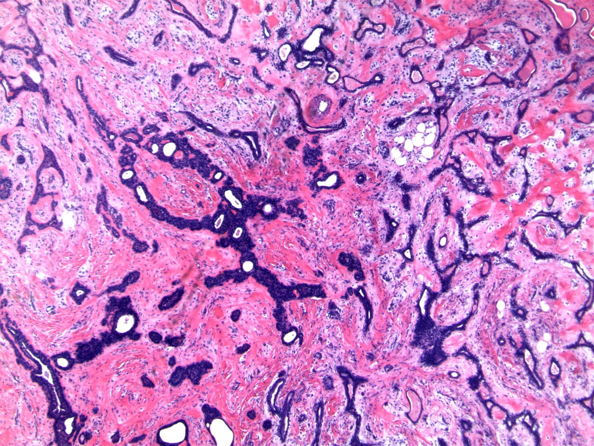 Image 2: Epithelial structures are associated with an eosinophilic ‘collarette’ in some areas, while other foci are surrounded by pale, myxoid stroma.