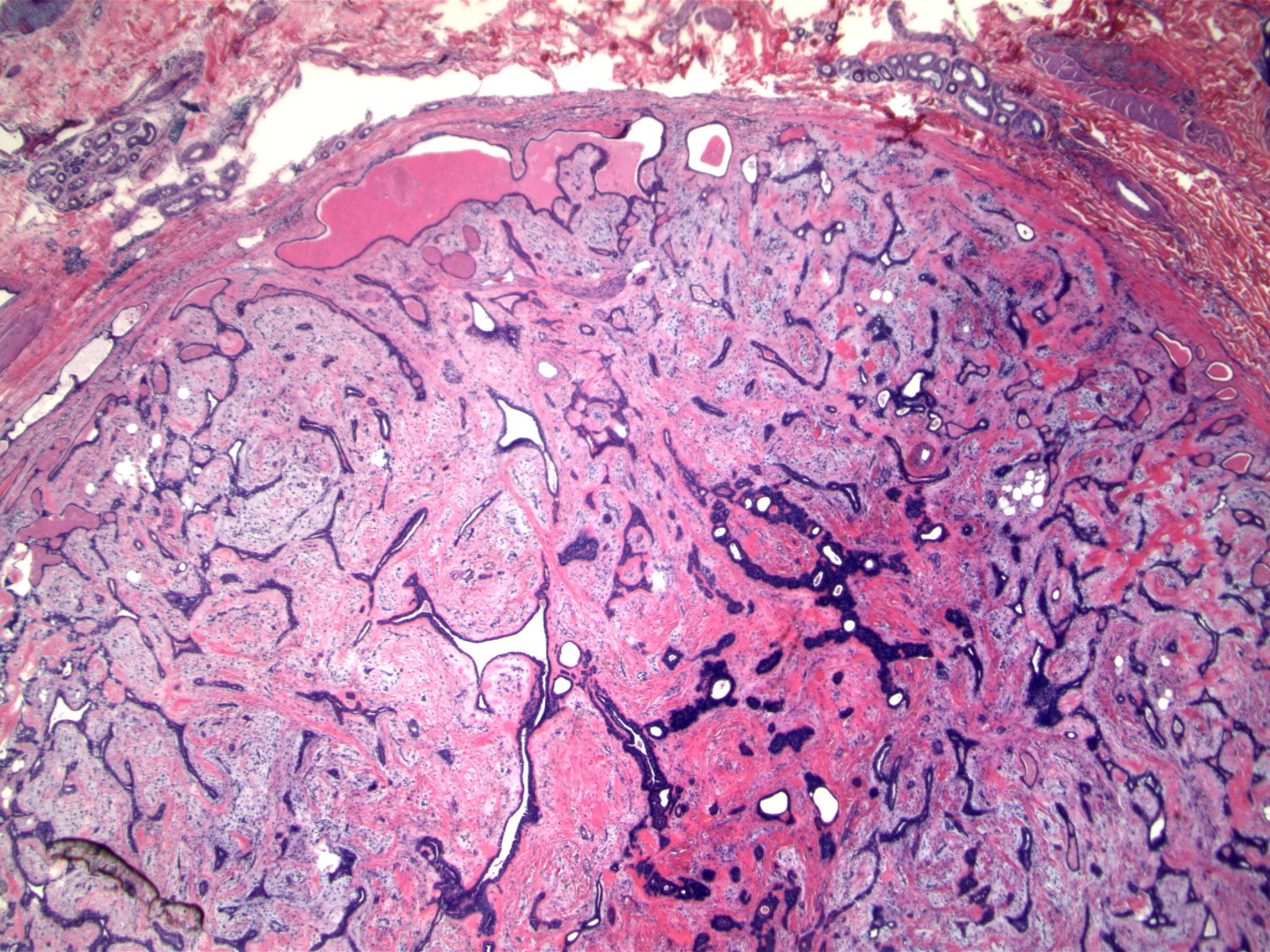 Image 4: Two groups of eccrine units at the top of the figure show this lesion to be present in the deep dermis/subcutaneous tissue and not breast proper.