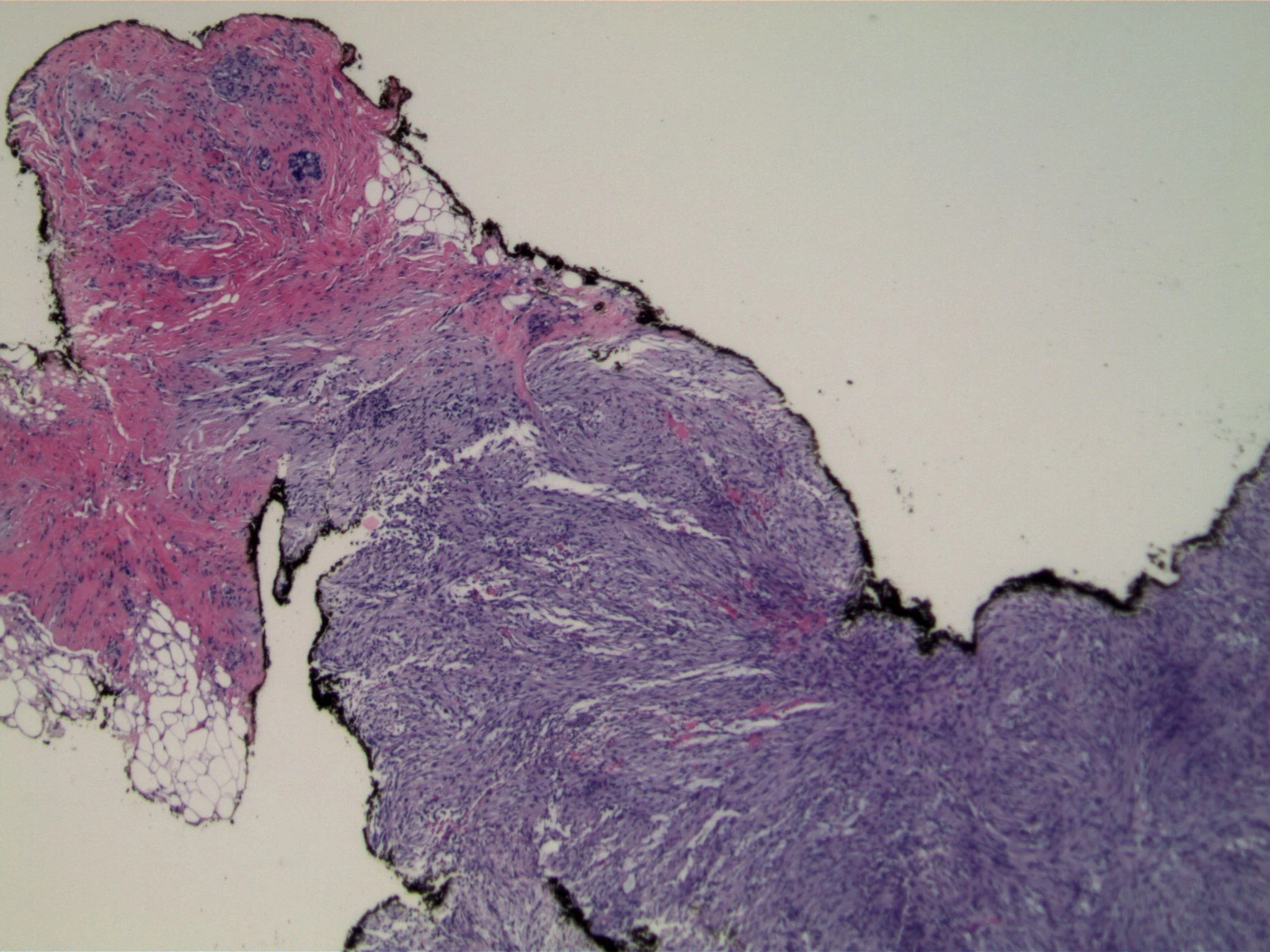 Image 1. Core needle biopsy specimen contains a spindled cell proliferation; note small amount of normal breast tissue at upper left.
