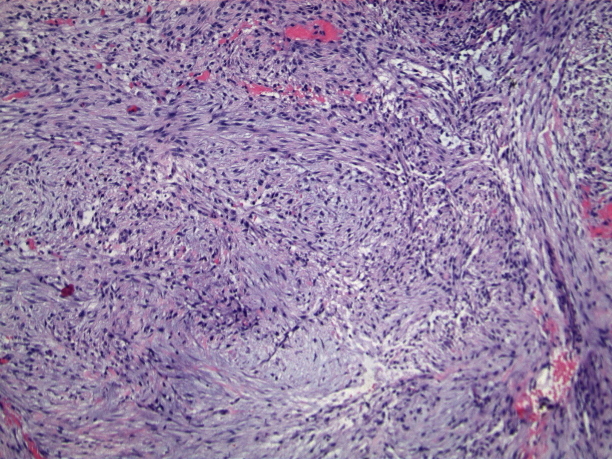 Image 2. Spindled cells are arranged in swirling fascicles and are associated with a myxoid background and focal hemorrhage.