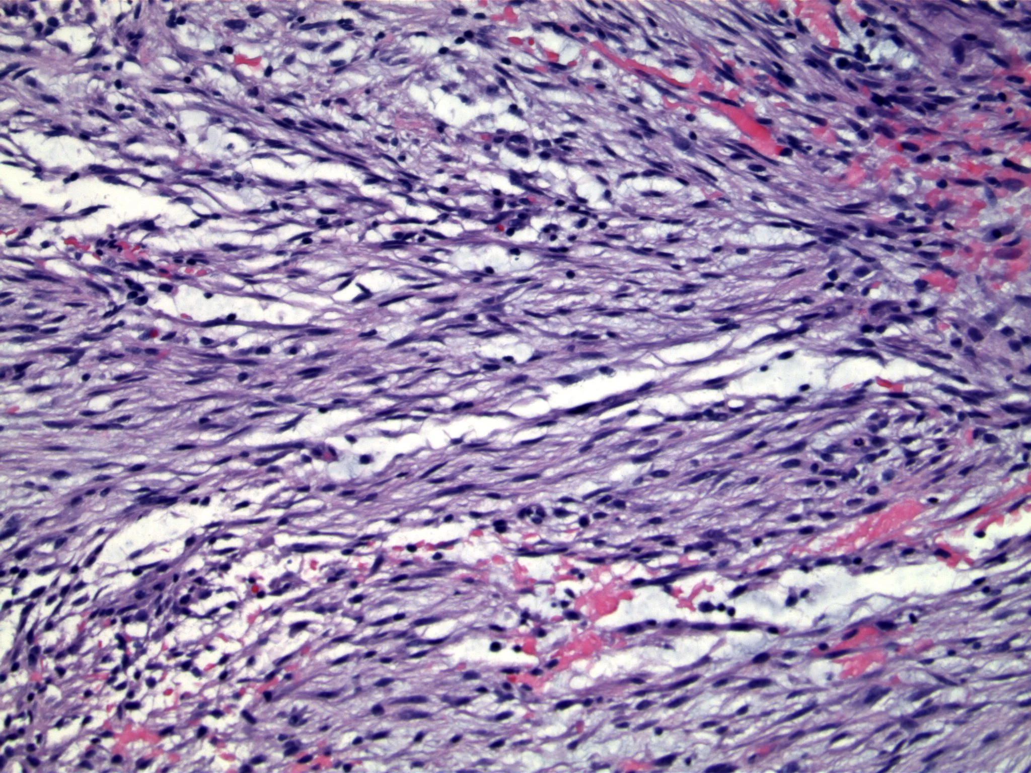 Image 3. Spindled cells have the appearance of cells in tissue culture. Note areas of hemorrhage.