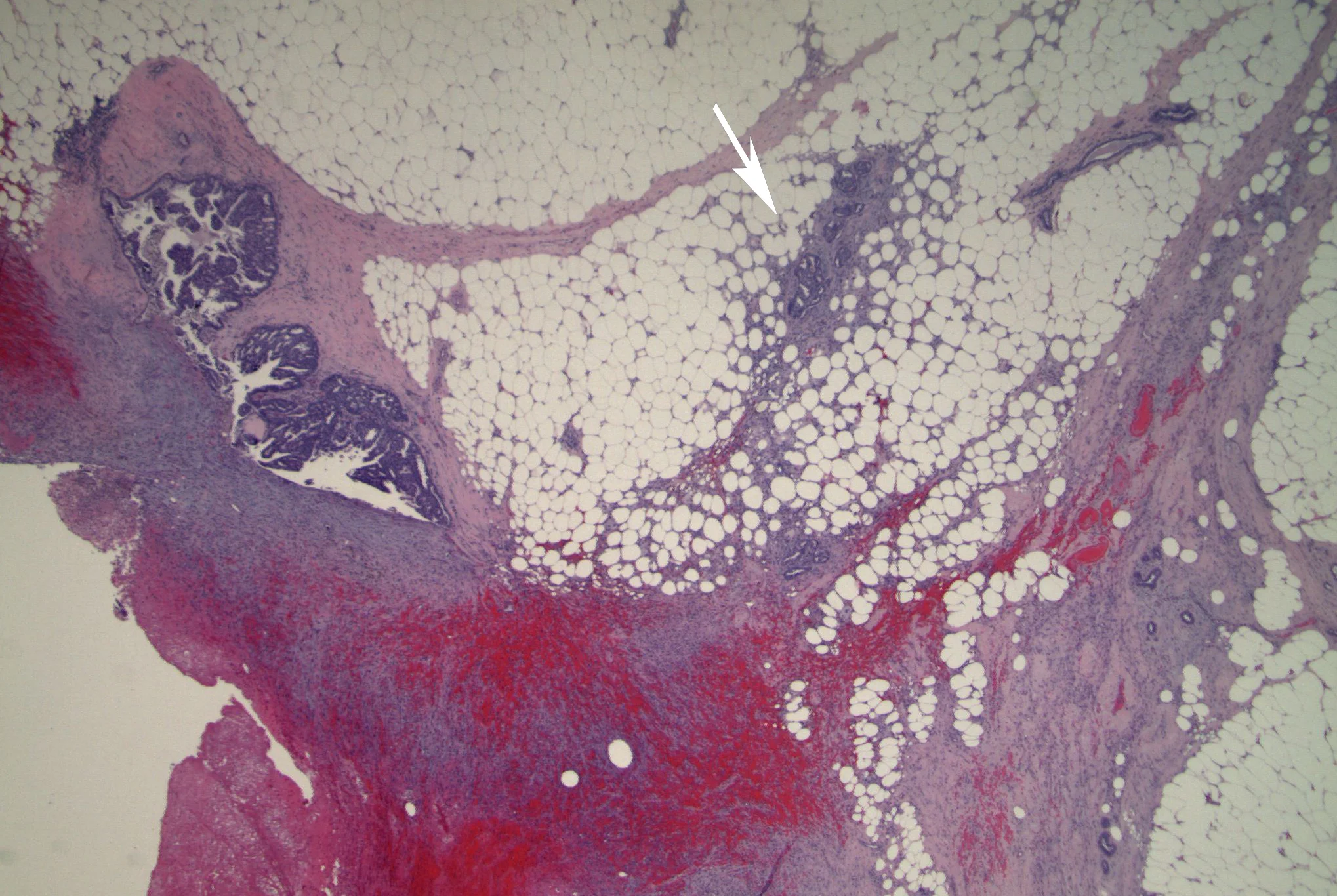 Image 1. Excisional biopsy specimen shows an epithelial proliferation within dilated ducts (left) and the recent biopsy site. Several separate small cellular nests (arrow) have an infiltrative appearance.