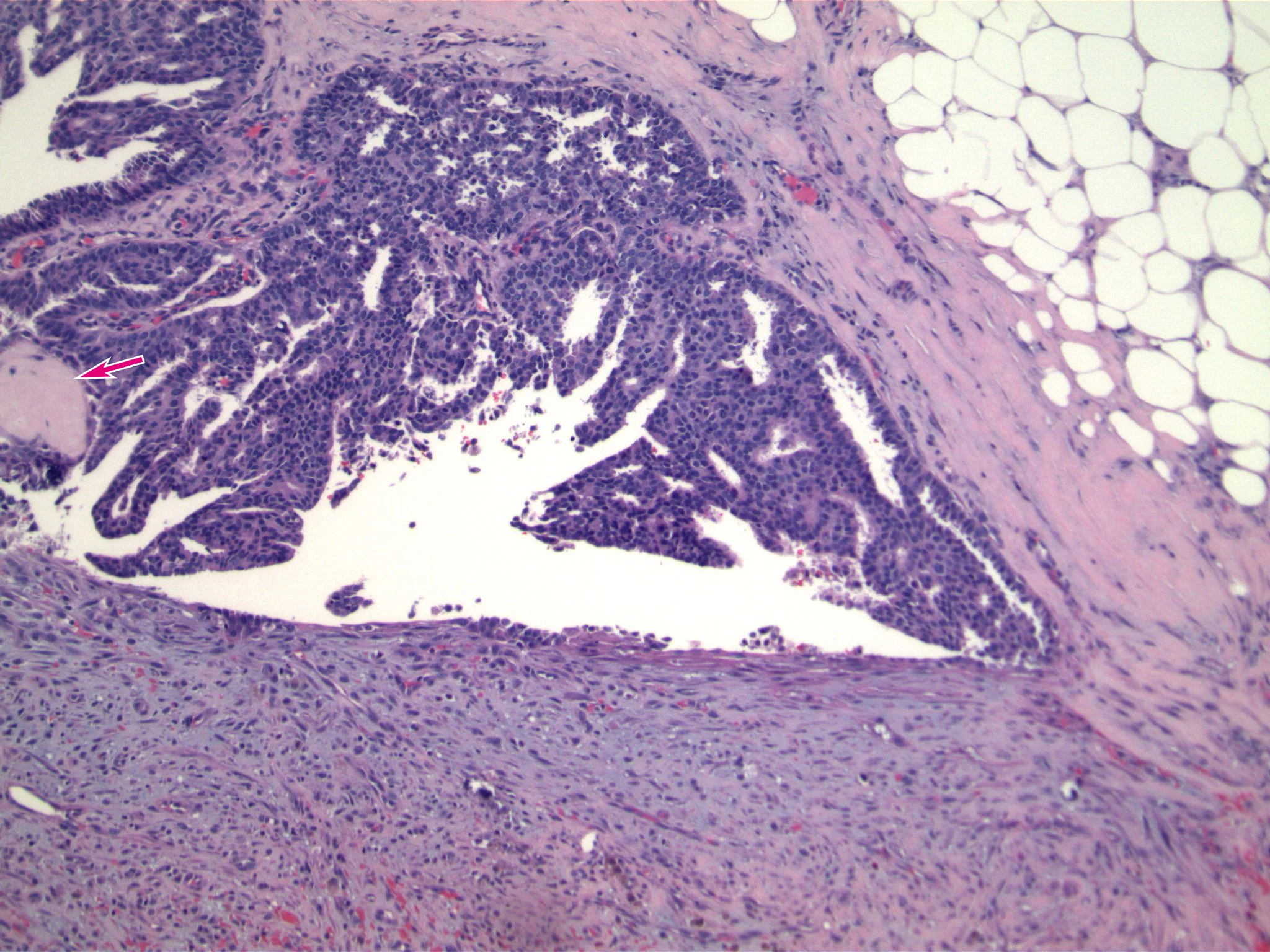 Image 2. The duct contain a uniform population of cells arranged as cribriform structures, diagnostic of low grade ductal carcinoma in situ. The DCIS involves a dilated duct, and there are a few fibrovascular cores (arrow) associated with the DCIS, characteristic of involvement of an intraductal papilloma. 