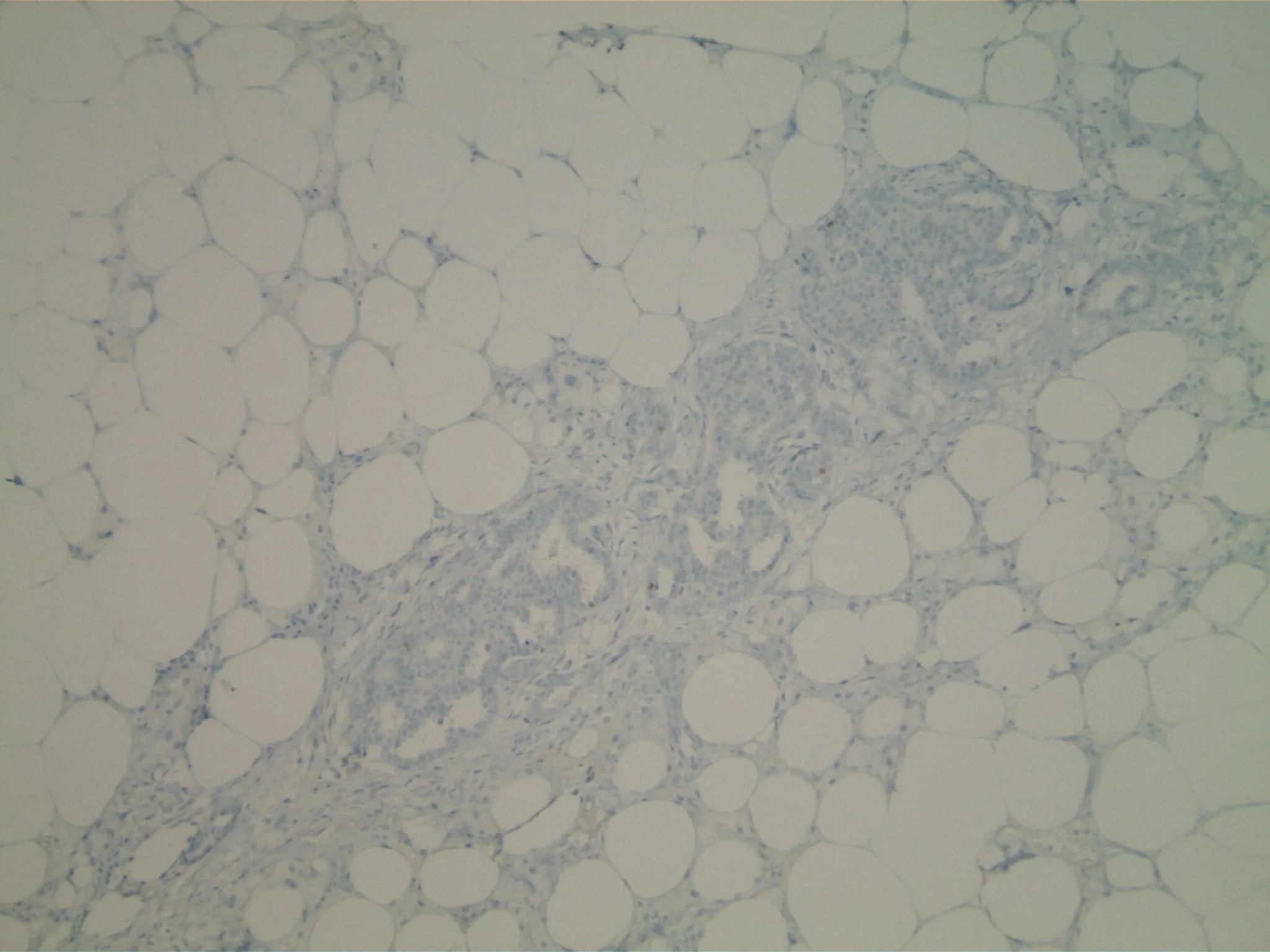 Image 4. Immunohistochemical studies using antibodies to p63 show only rare myoepithelial cells ASSOCIATED WITH THE SMALL CRIBRIFORM STRUCTURES.
