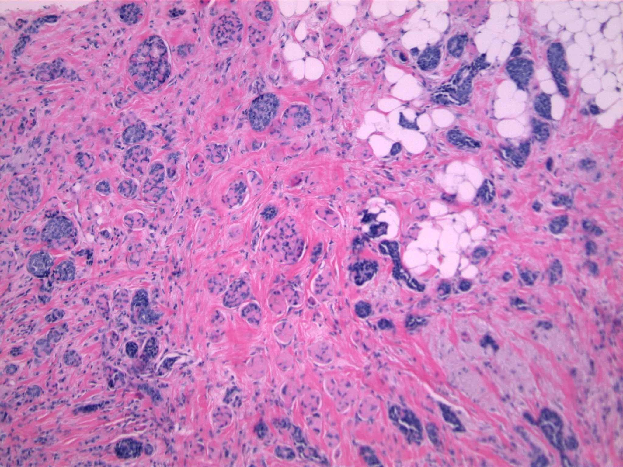 Image 2. Higher power shows infiltrative nests extending into fat. The infiltrating nests are composed of bland cells, and there is no mitotic activity.