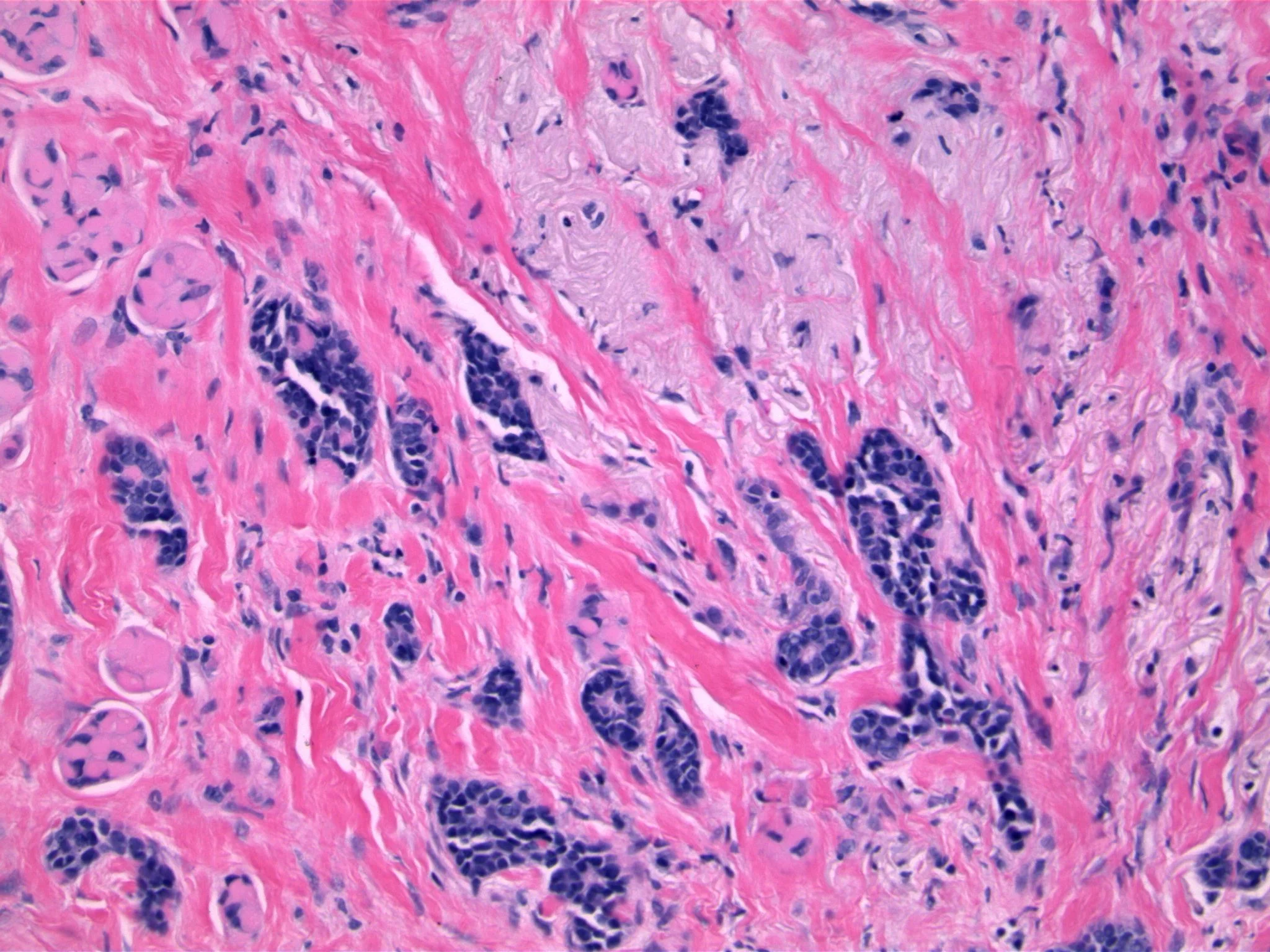 Image 3. Higher power shows two distinct cell types; small glands are composed of bland luminal epithelial cells, and small rounded nests are composed of myoepithelial cells stuffed with abundant eosinophilic basement membrane material. The basement membrane material is so prominent that the associated cells are inconspicuous in some areas. 