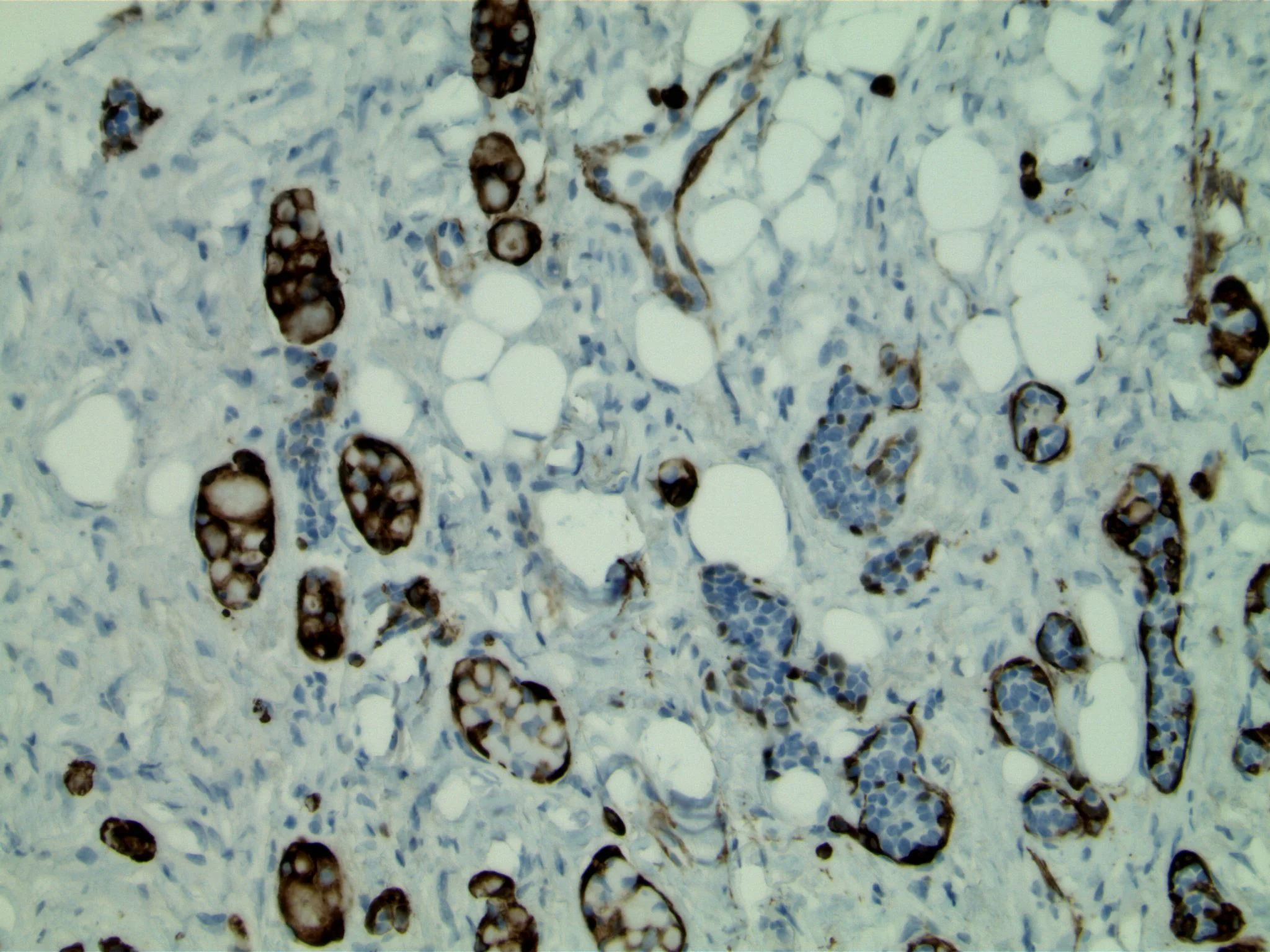 Image 4 . Immunohistochemical study using antibodies to p63 highlights dual cell population, and prominent myoepithelial component