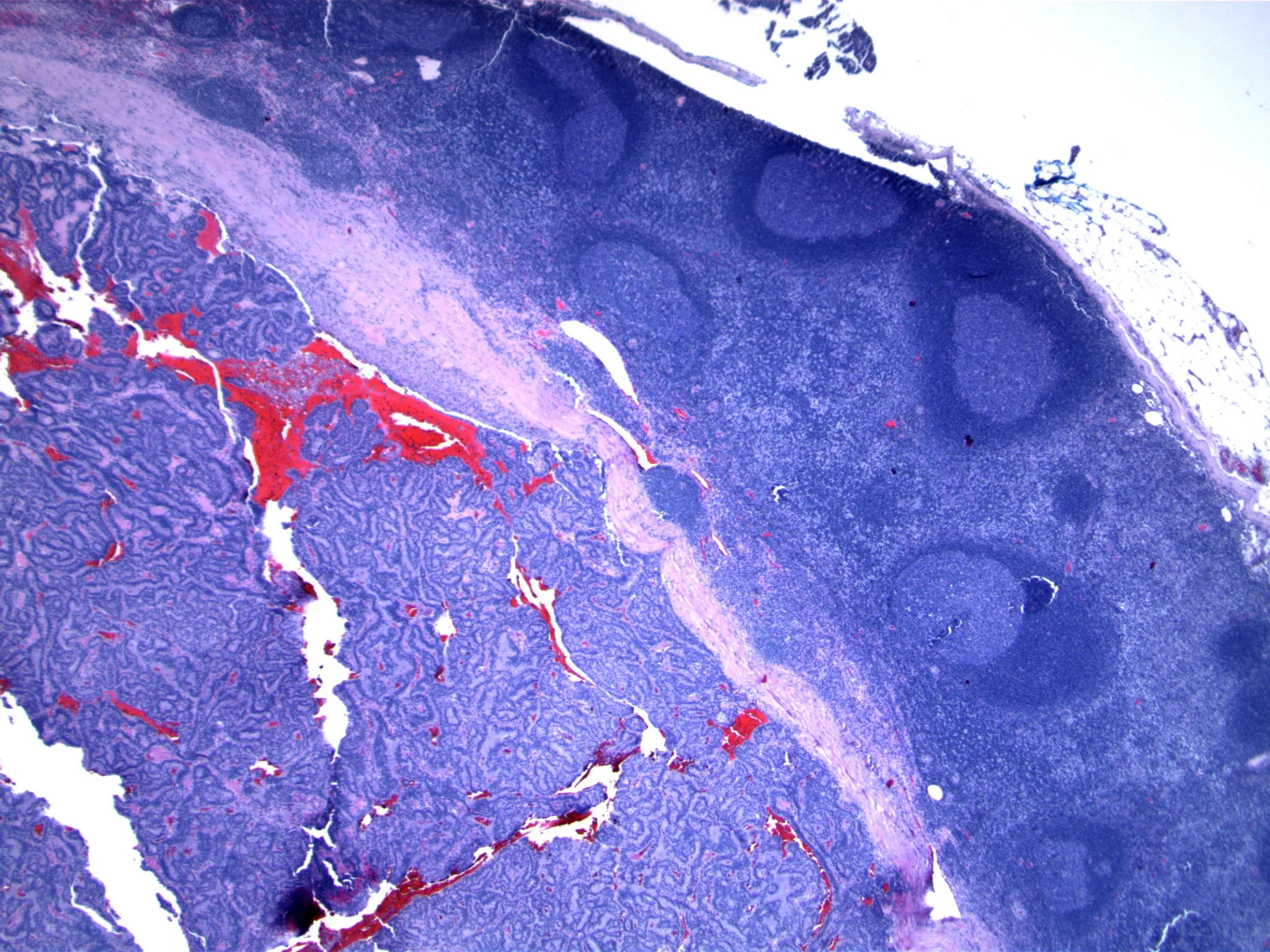 Image 1. A lymph node contains an epithelial proliferation.