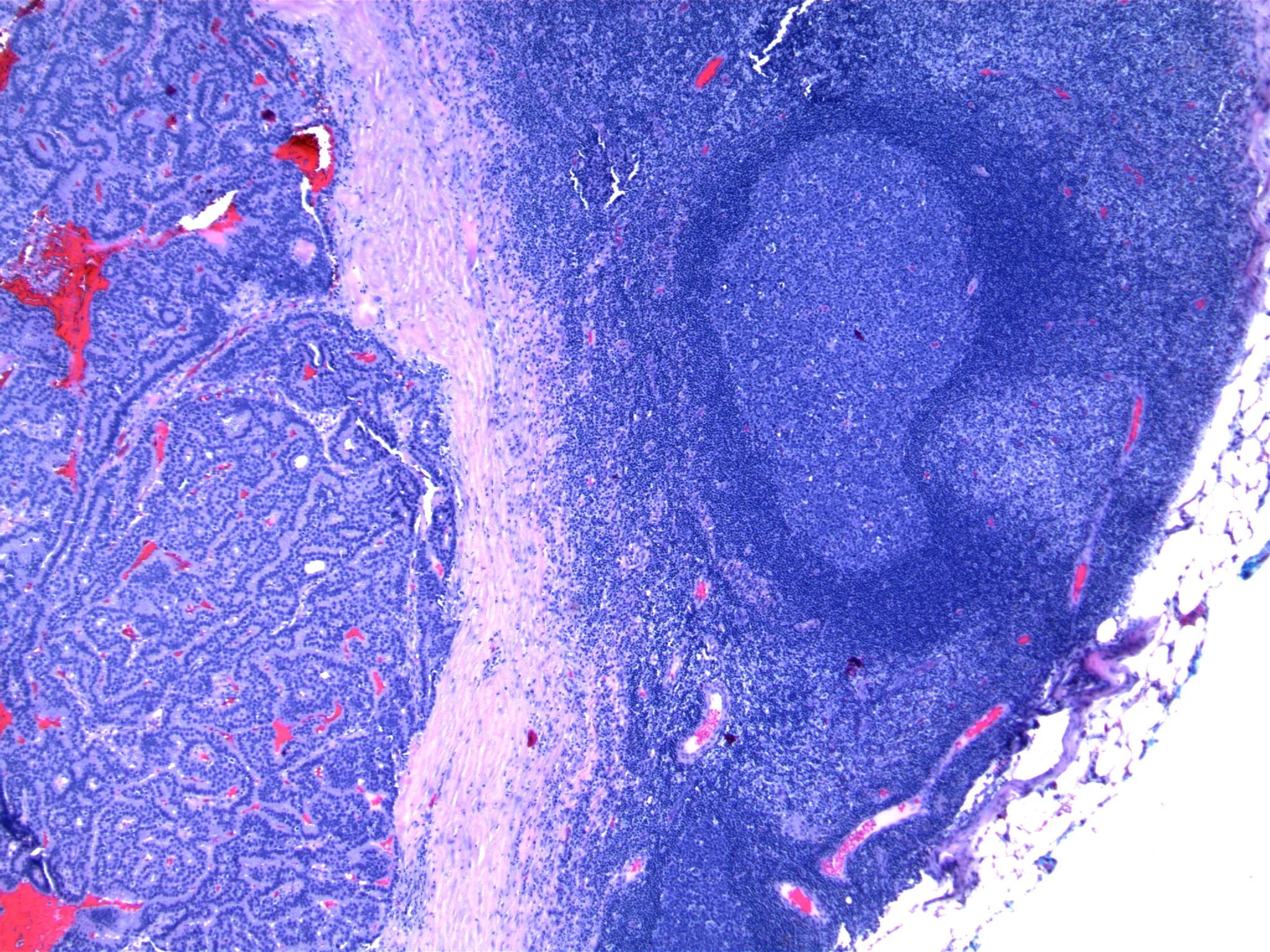 Image 2. Epithelial proliferation has a rounded configuration.
