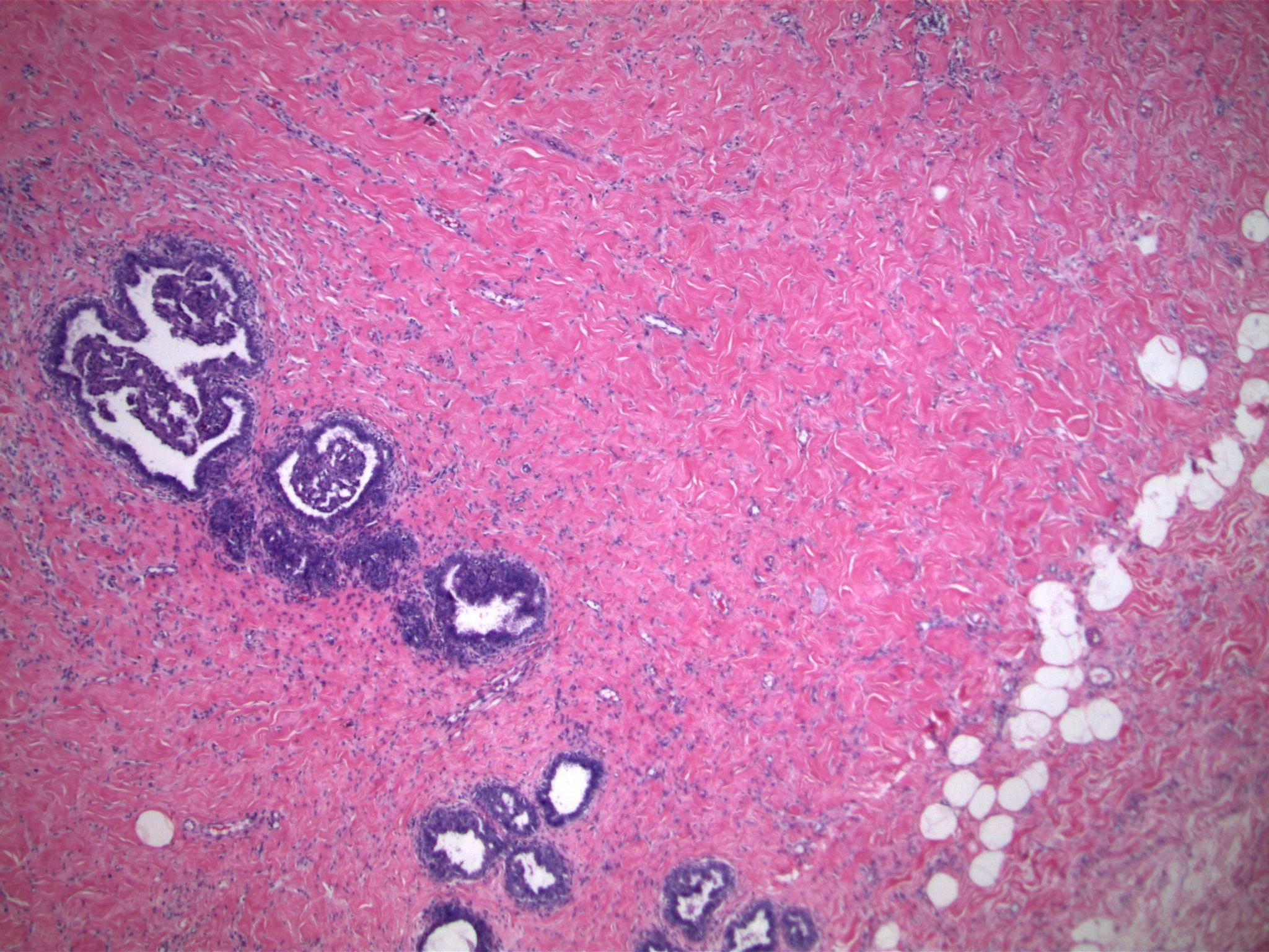 Image 1. Dense stromal fibrosis surrounds a lobular unit that contains an epithelial proliferation.