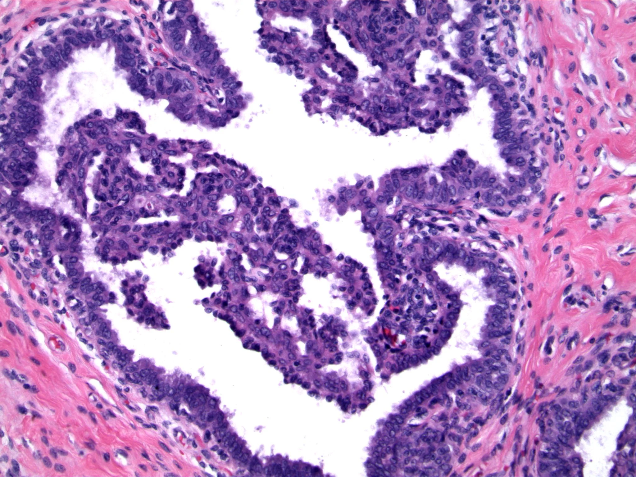 Image 2. Although the epithelial proliferation is exuberant, the micropapillae are thin and tapering, reminiscent of the hyperplasia seen in gynecomastia. nuclei are variable, and cellular overlap is evident. the tips of the micropapillae contain pyknotic cells