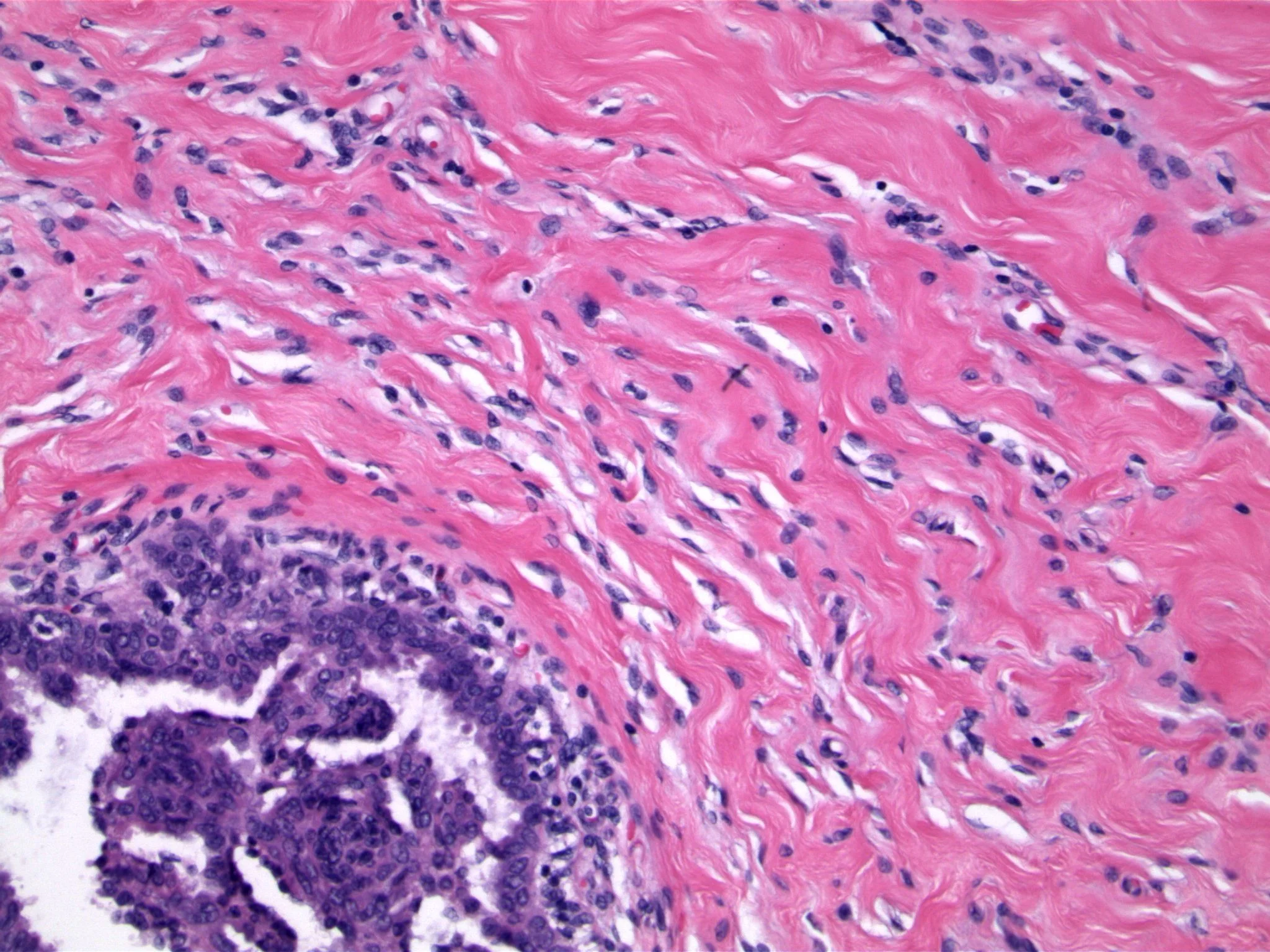 Image 2. the dense stroma has flattened pseudovascular spaces. micropapillary projections are present within the lobular unit. 