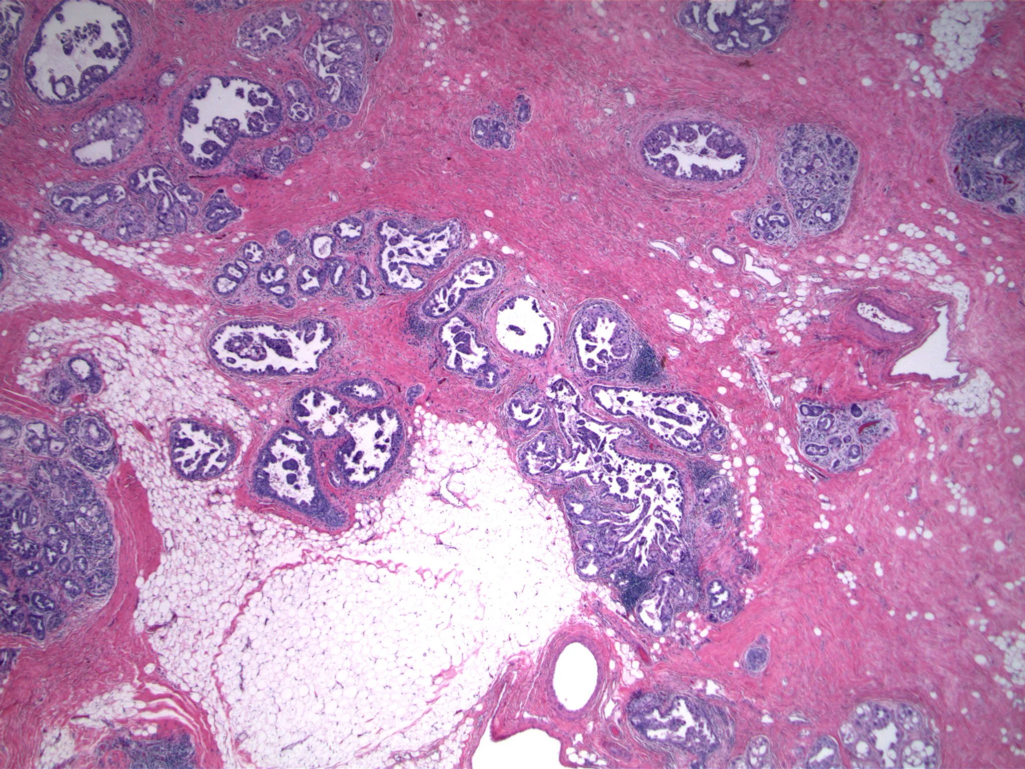 Image 1. Numerous lobular units and true ducts are expanded by a proliferation of neoplastic cells that form micropapillary structures.