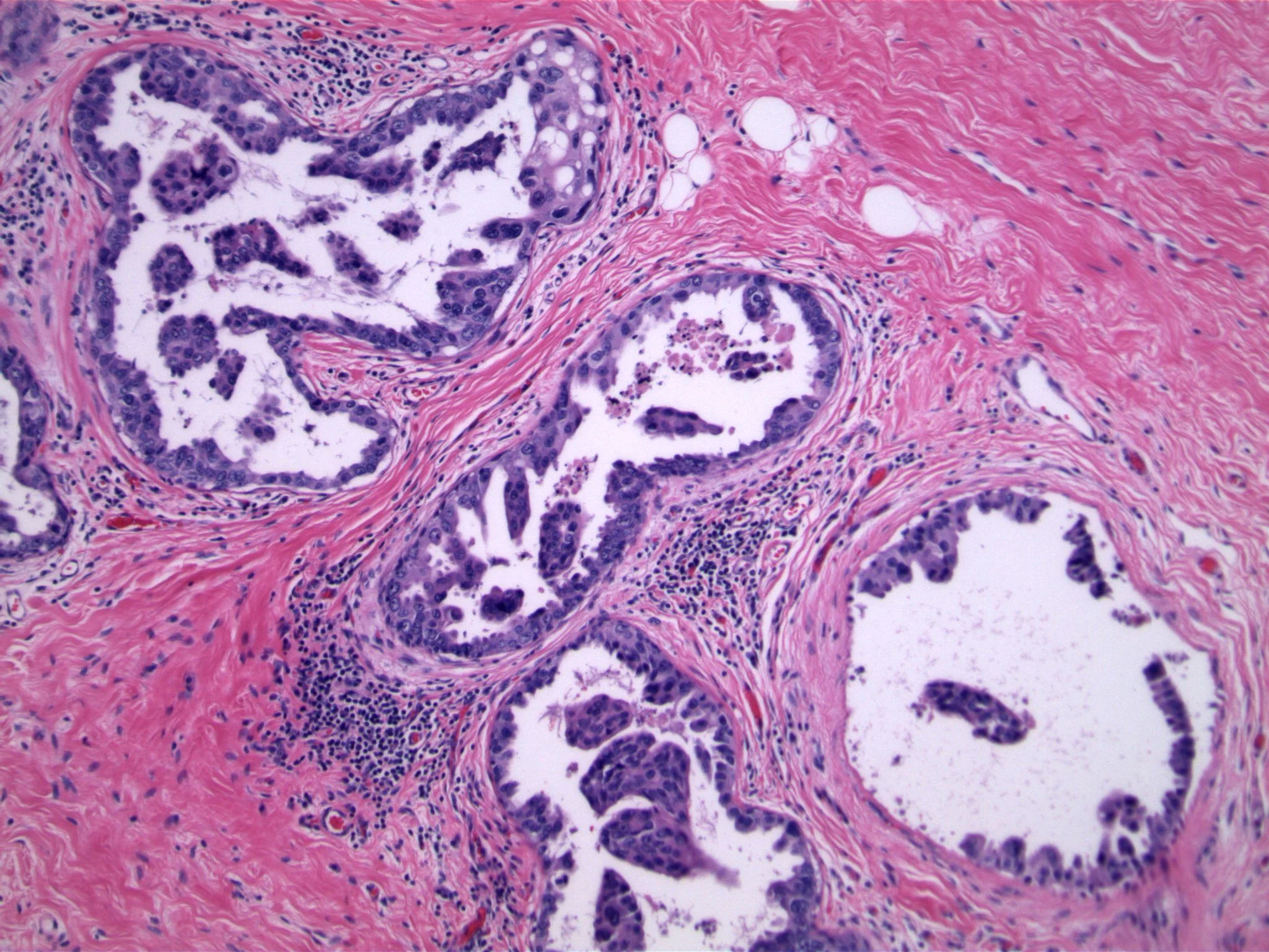 Image 2. High grade micropapillary ductal carcinoma in situ with central necrosis.