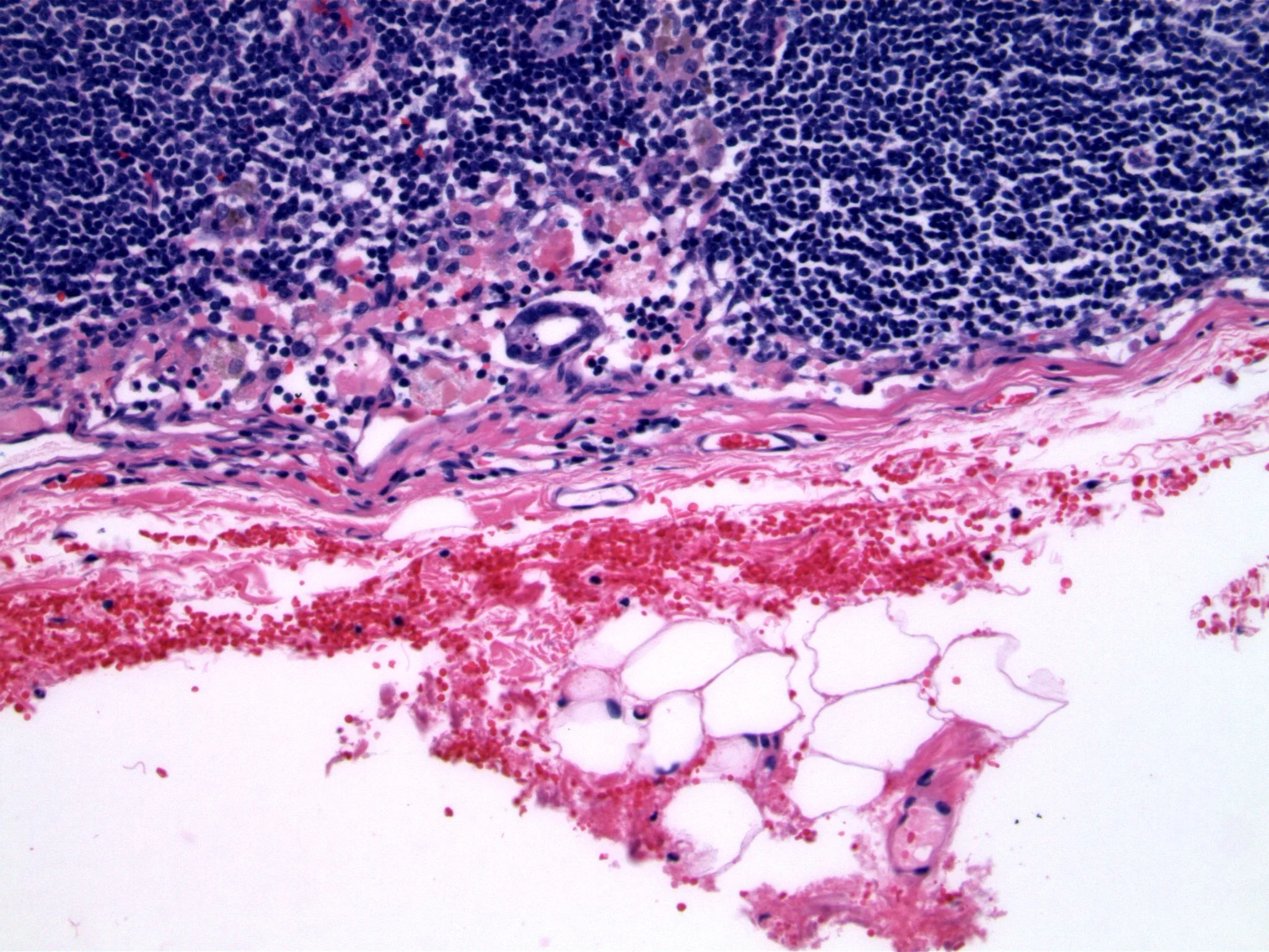 Image 3. An epithelial cluster is present in the subcapsular sinus in the sentinel lymph node. There are numerous hemosiderin-laden histiocytes and degenerating red blood cells.