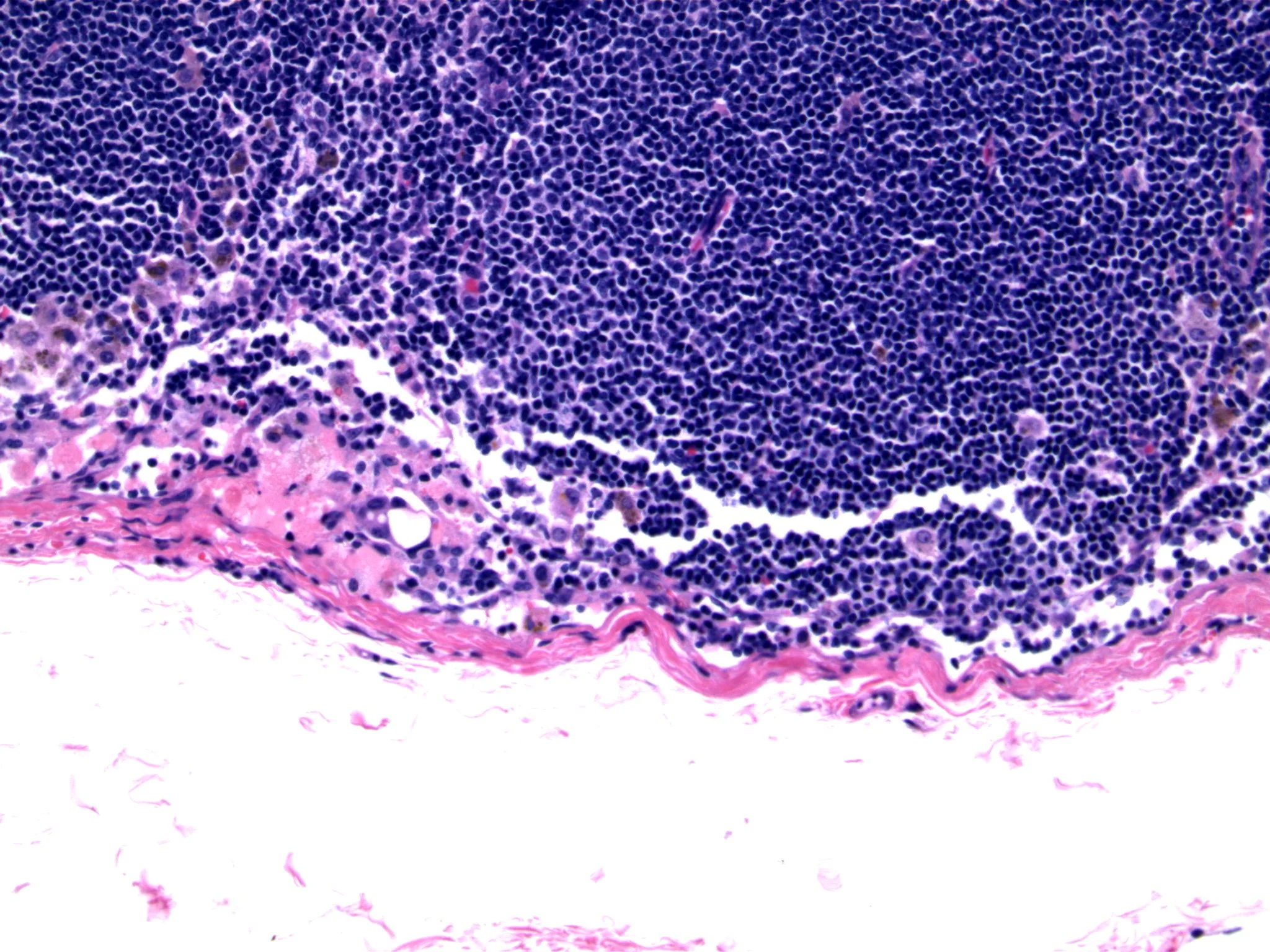 Image 4. Degenerating epithelial cell cluster associated with fragmented red blood cells and hemosiderin-laden histiocytes.