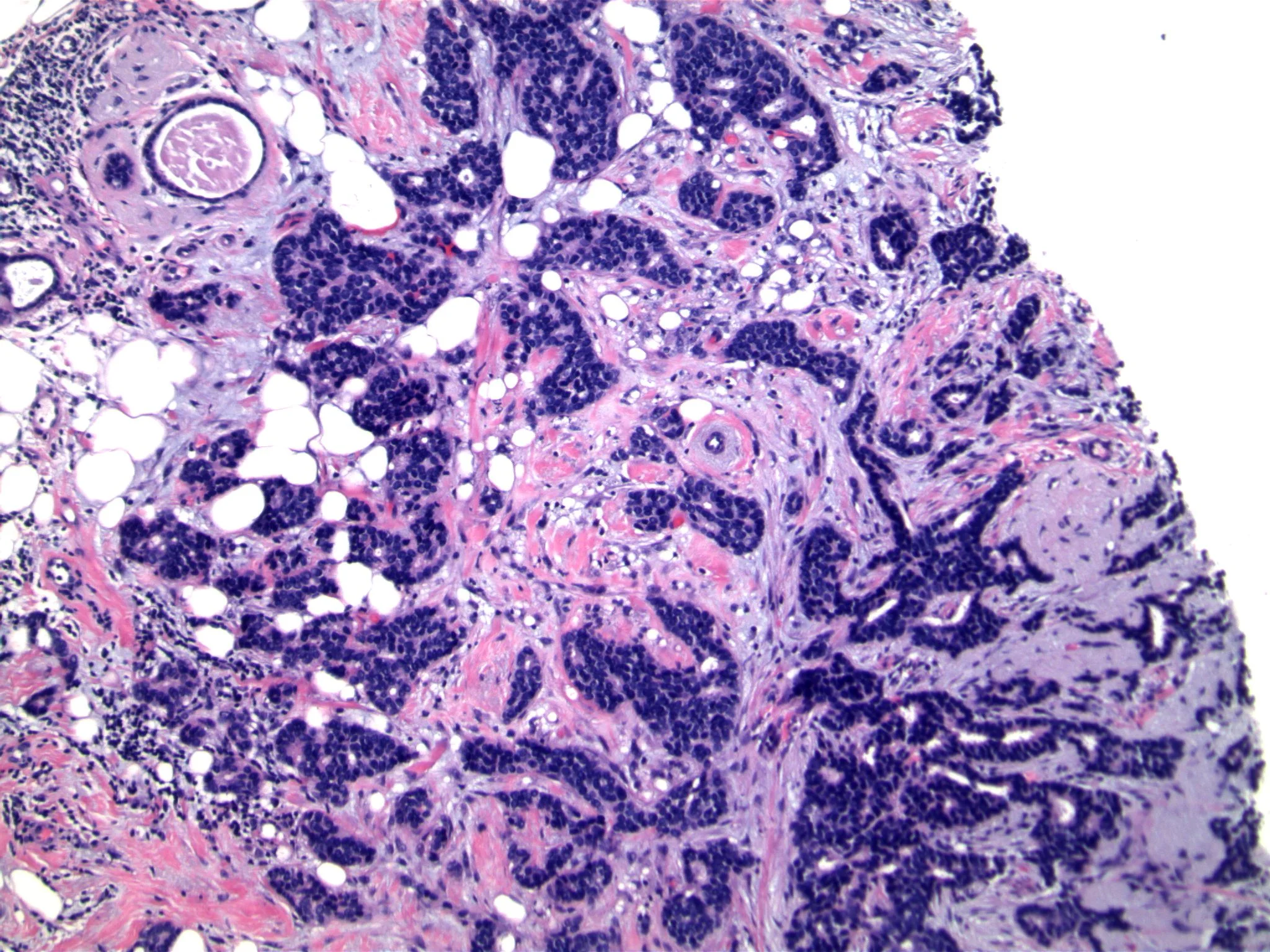 Image 2. Invasive carcinoma showing focal cribriform architecture, with diffuse infiltration into fat. Note normal acinus, top left.