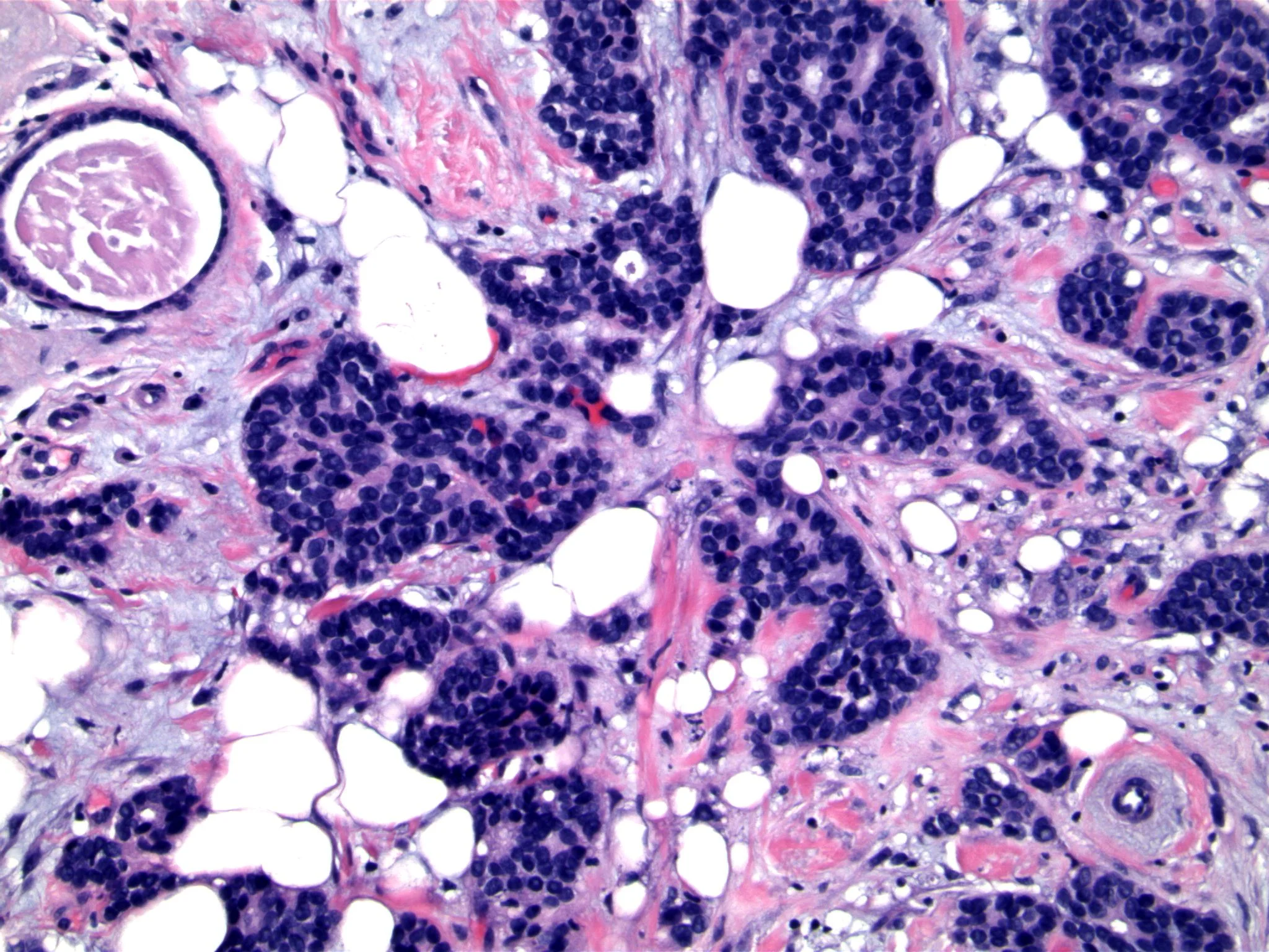 Image 3. Invasive carcinoma is composed of small, uniform cells with ‘basaloid’ appearance, but no mitotic activity.