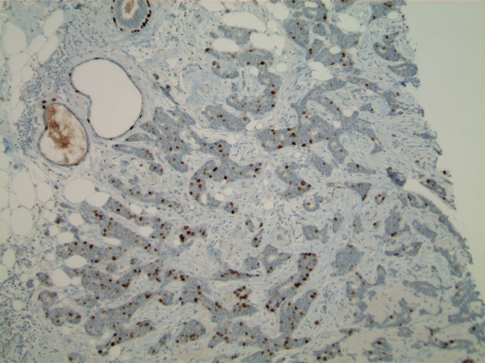 Image 4. Immunohistochemistry using antibodies to p63. Most tumor nests contain some p63 expression by the neoplastic cells.