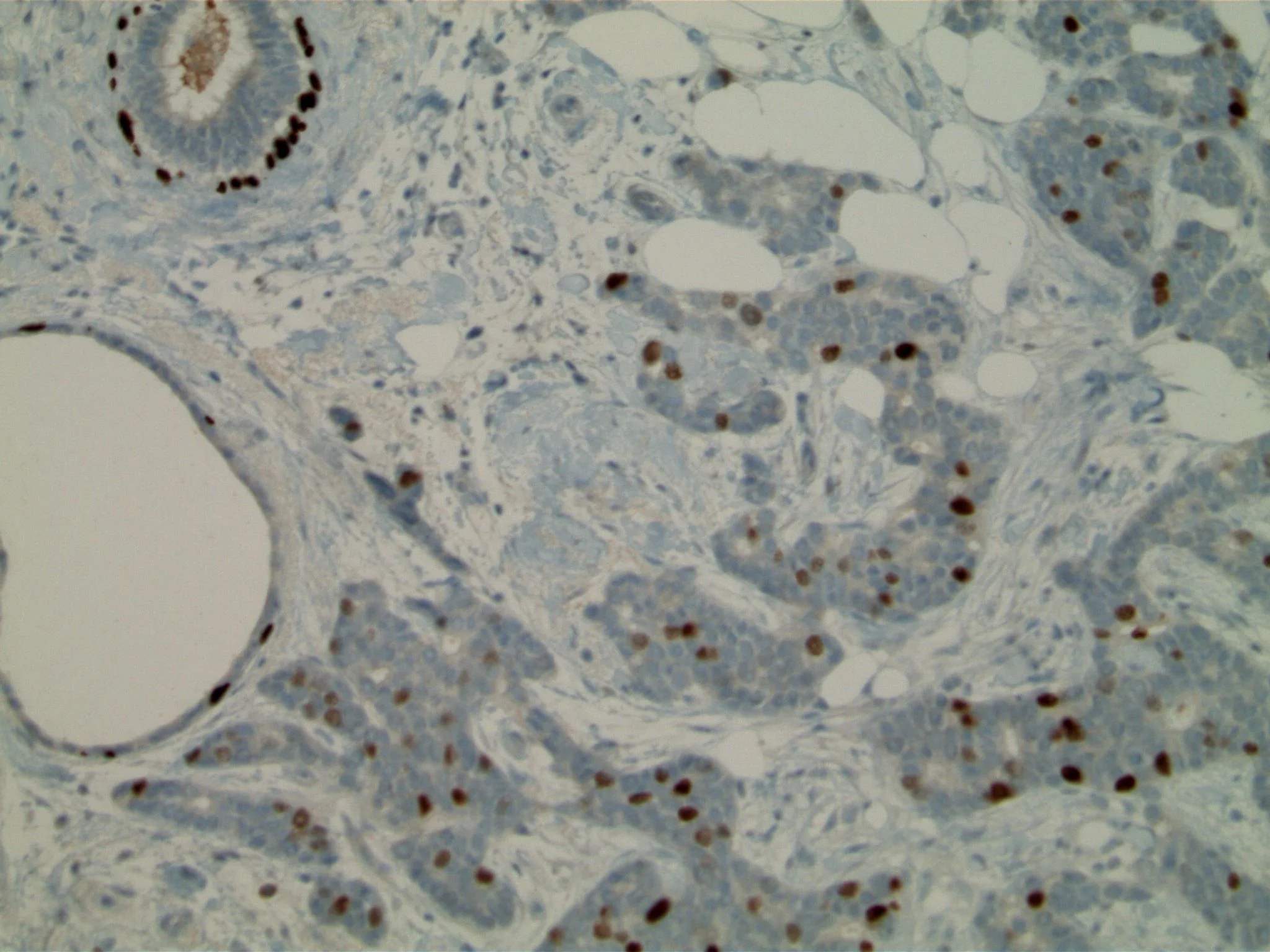 Image 5. The carcinoma expresses p63; note normal myoepithelial arrangement in benign gland, upper left.