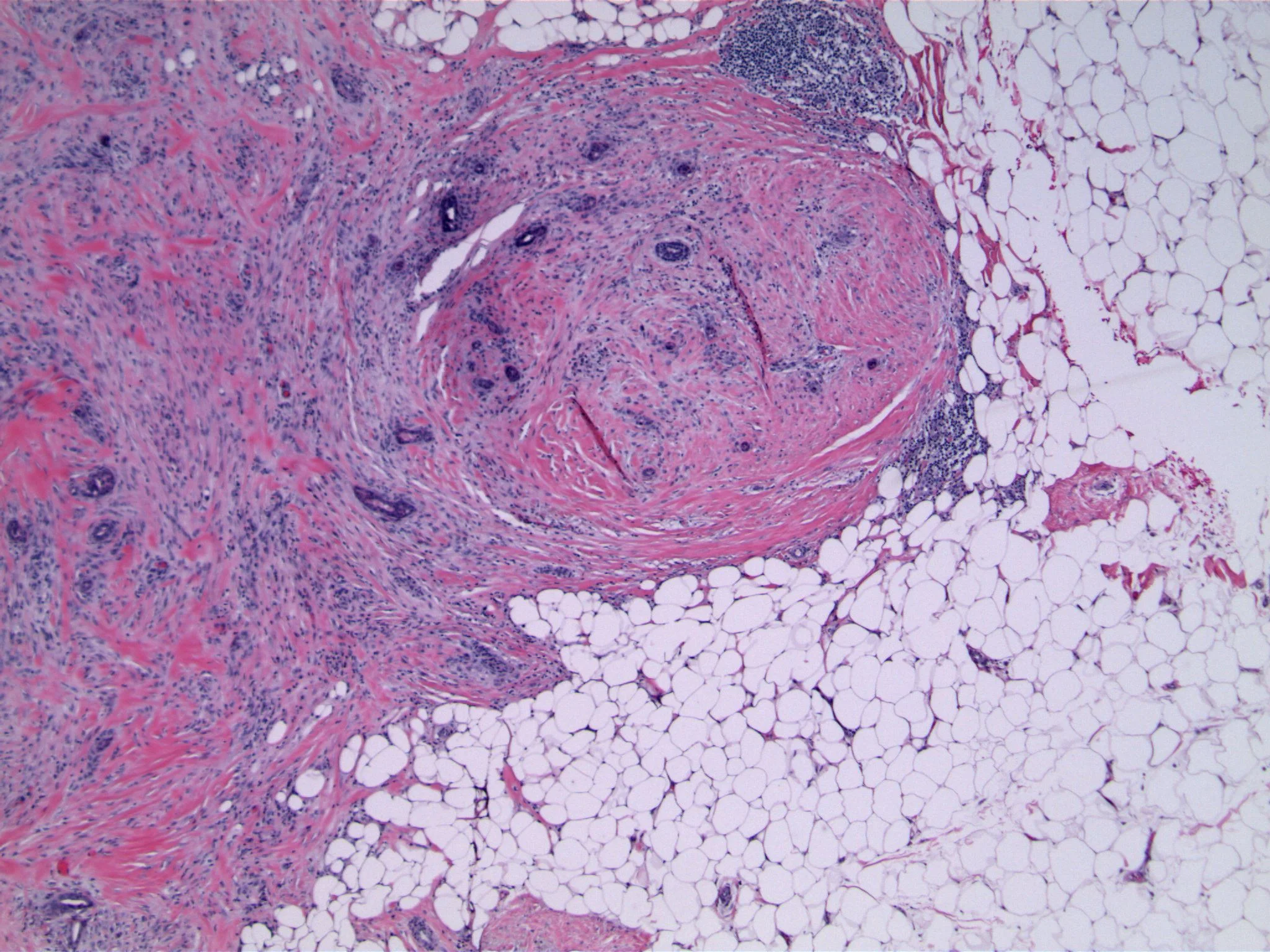 Image 5. Higher magnification showing glandular structures, some with squamoid features, admixed with cellular stroma composed of spindled cells