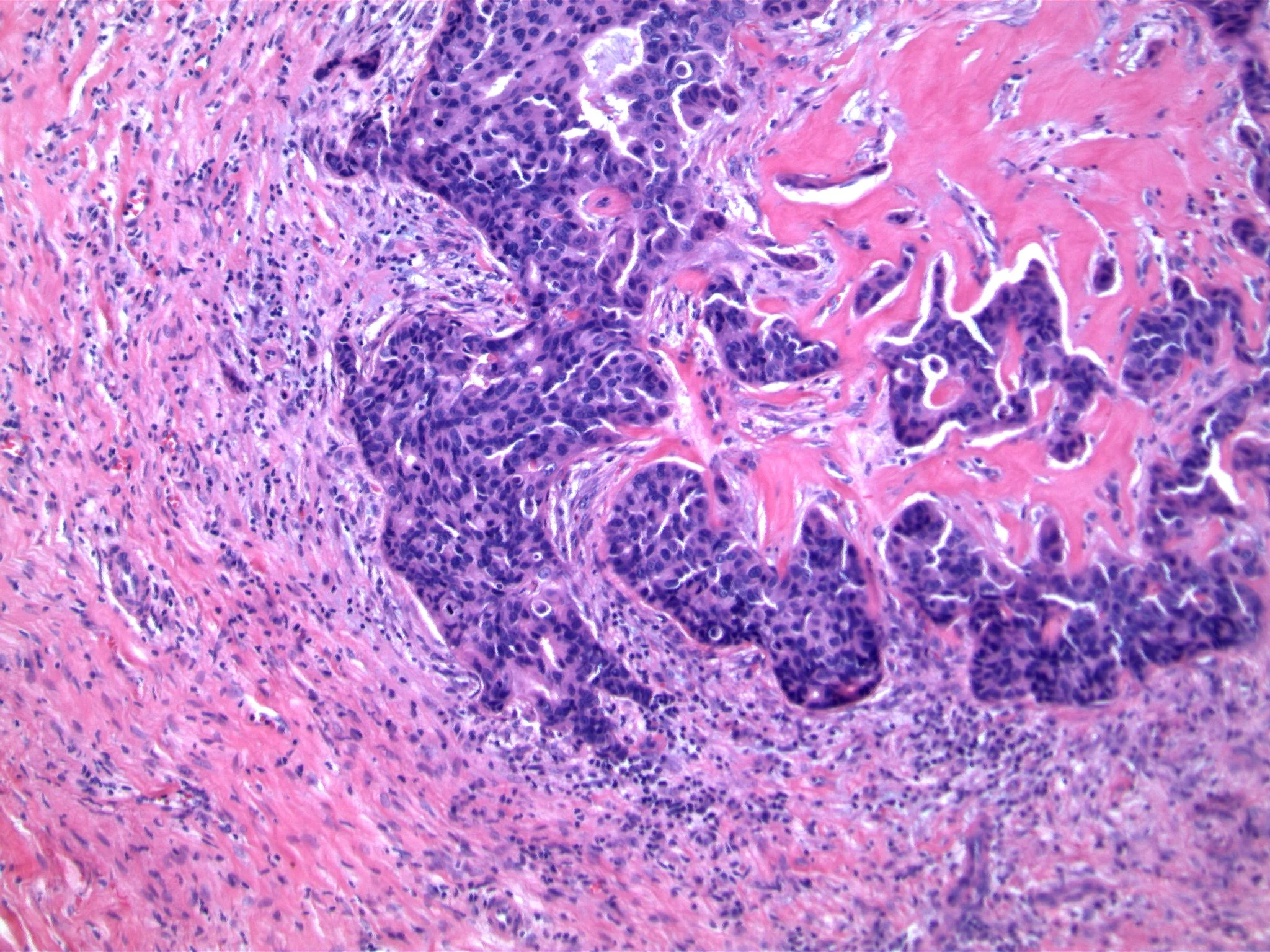Image 4. Irregular nests are associated with disrupted fibrovascular cores of intraductal papilloma
